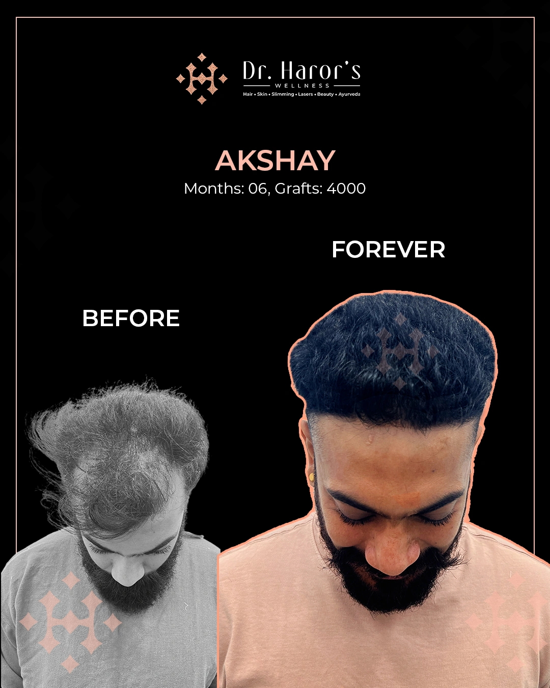 Hair Transplant Results in Delhi NCR India