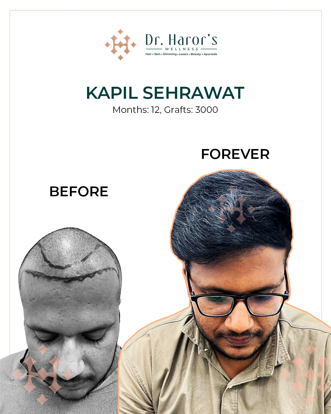 Hair Transplant Results in Delhi NCR India