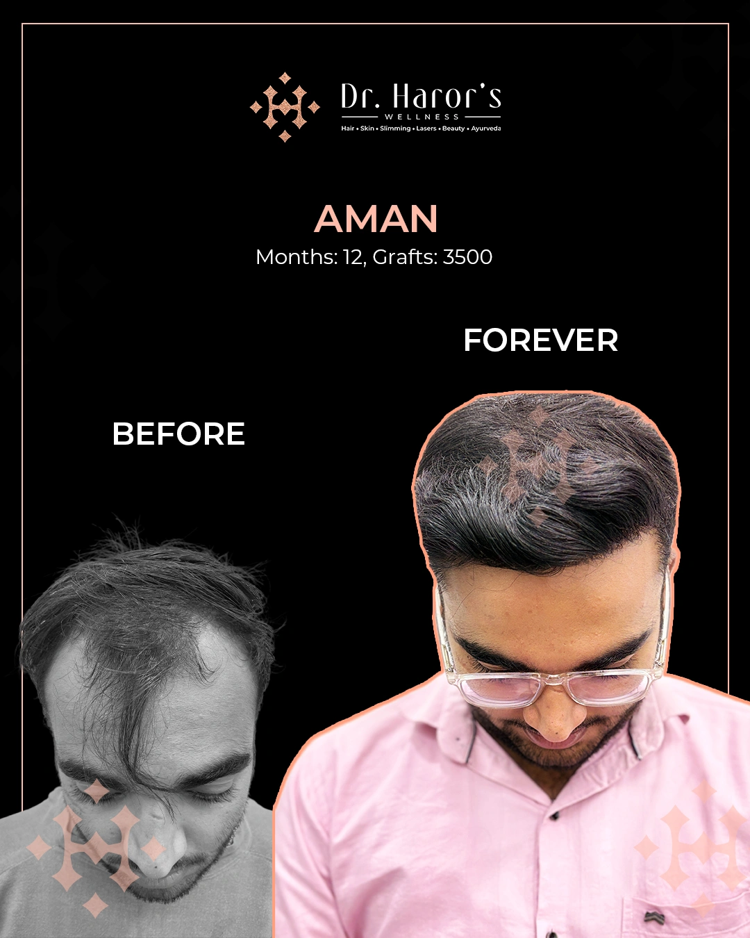 Hair Transplant Results in Delhi NCR India