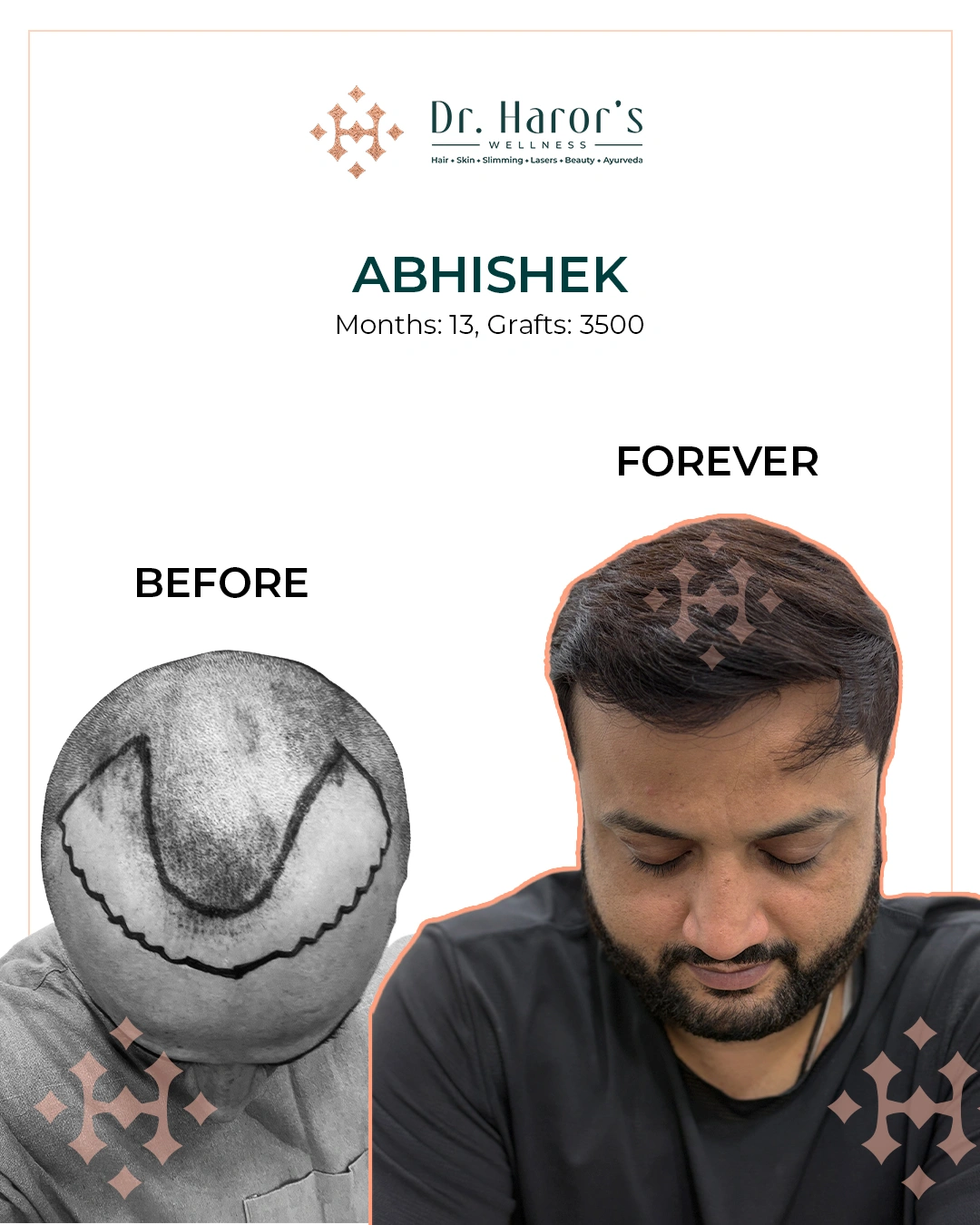 Hair Transplant Results in Delhi NCR India