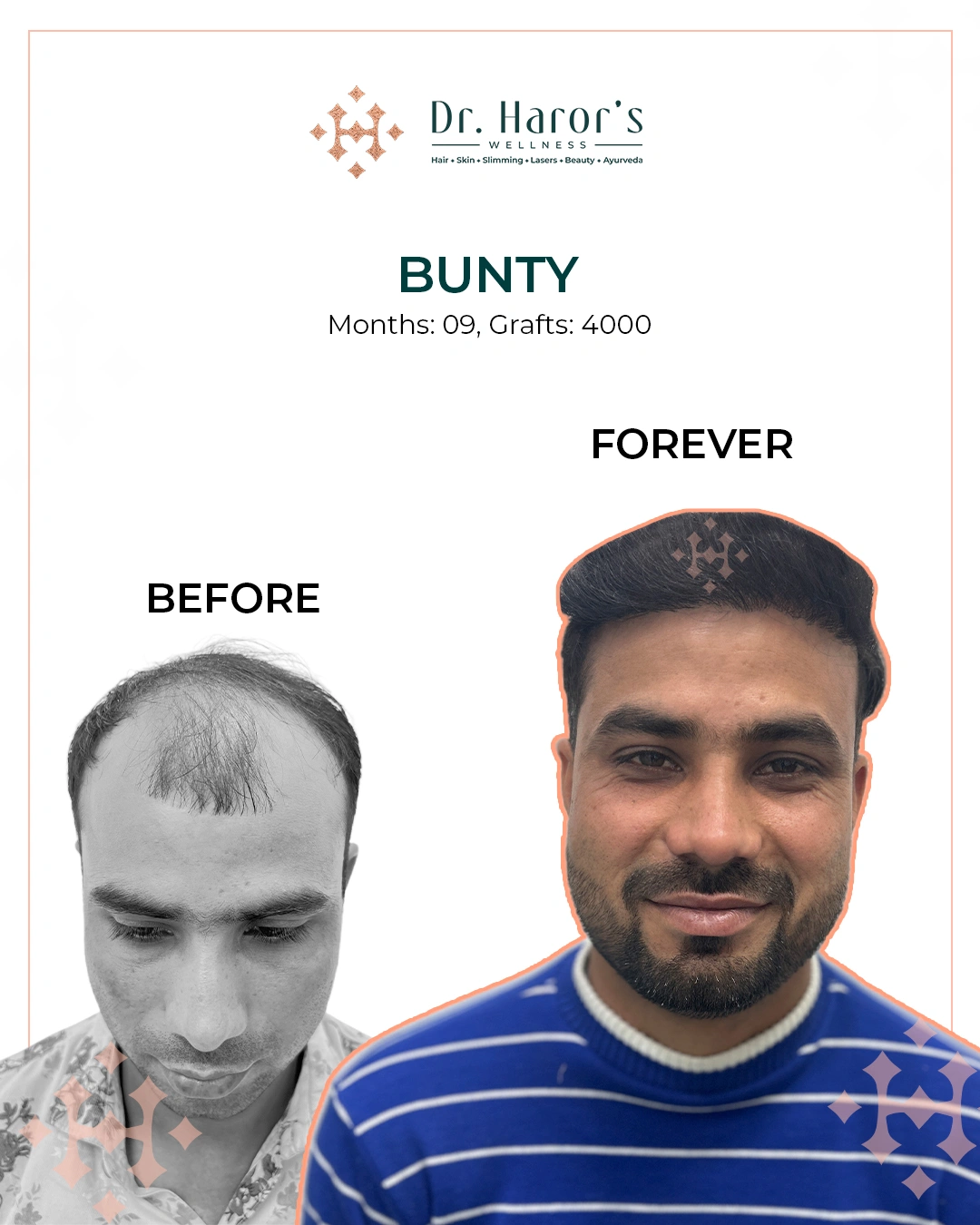 Hair Transplant Results in Delhi NCR India
