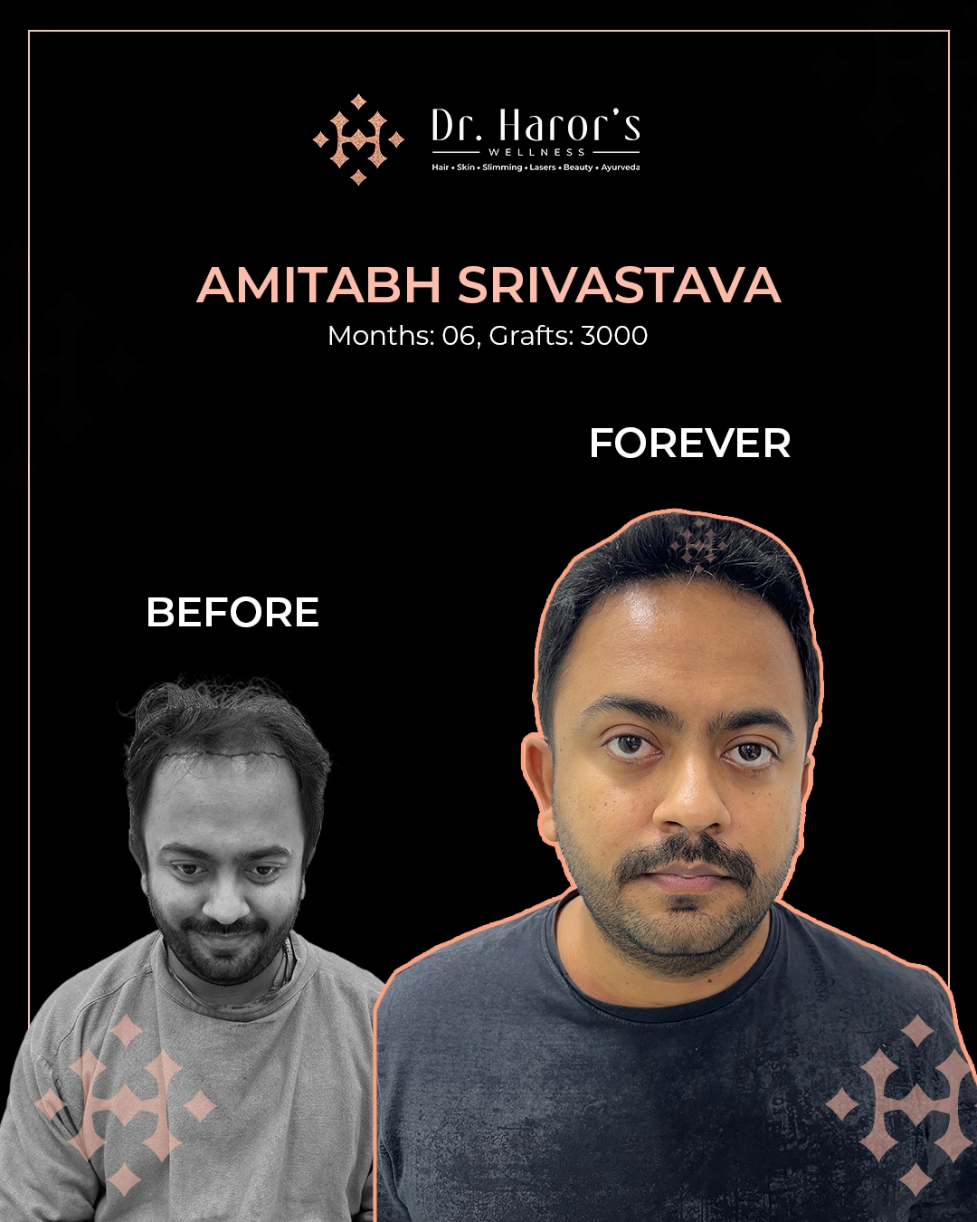 Hair Transplant Results in Delhi NCR India