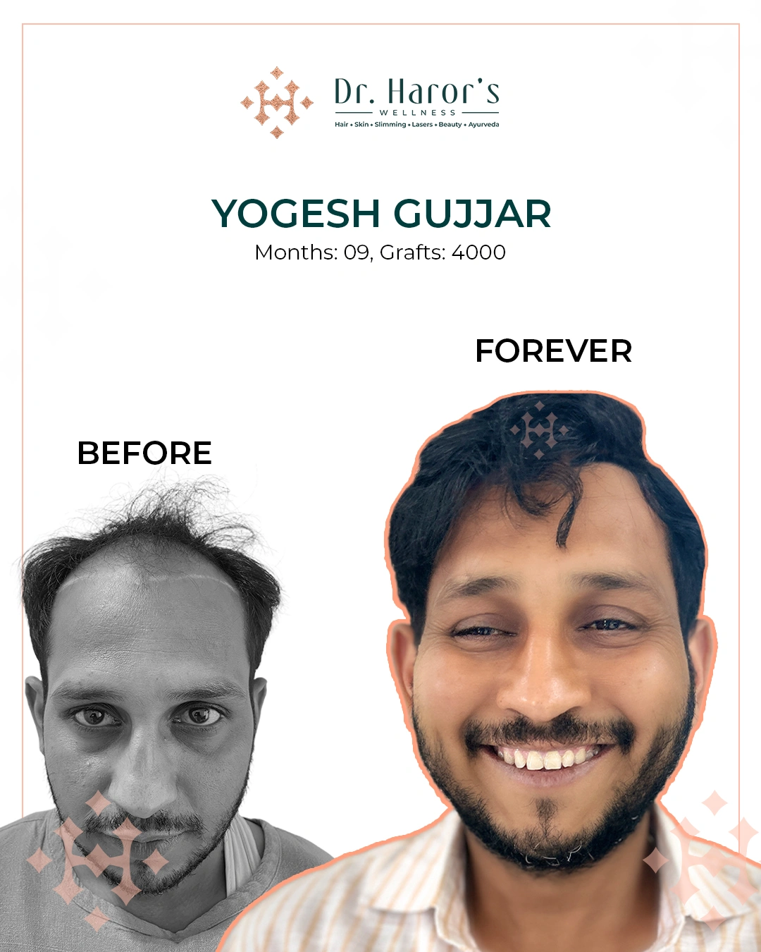 Hair Transplant Results in Delhi NCR India