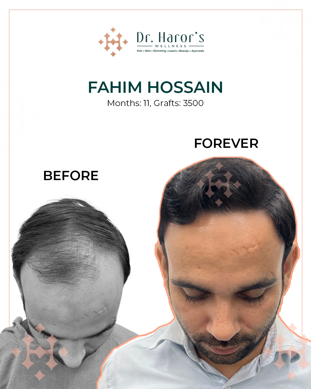 Hair Transplant Results in Delhi NCR India