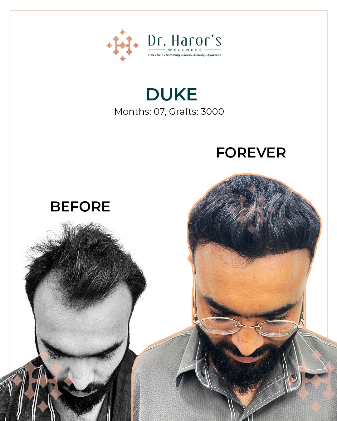Hair Transplant Results in Delhi NCR India