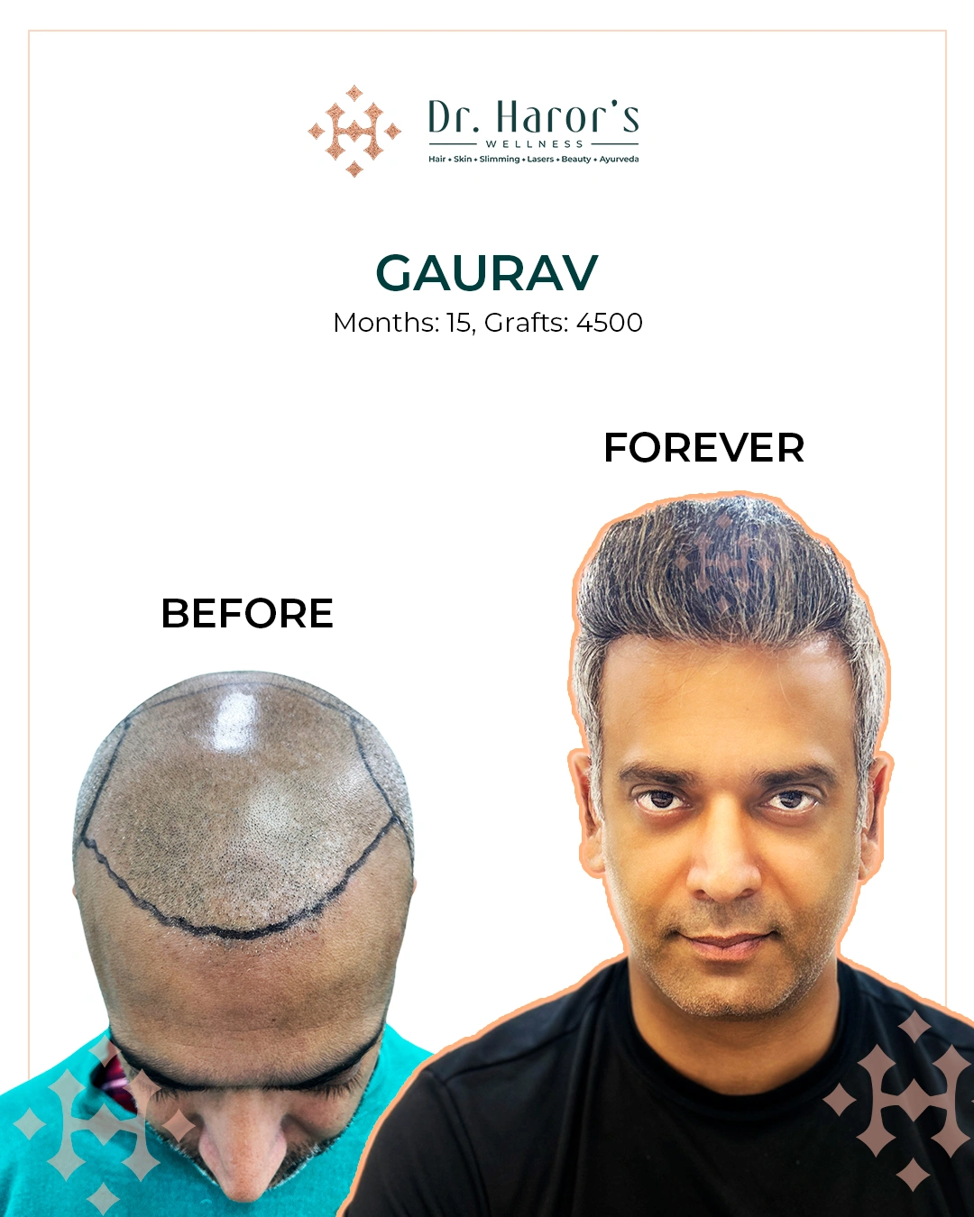 Hair Transplant Results in Delhi NCR India