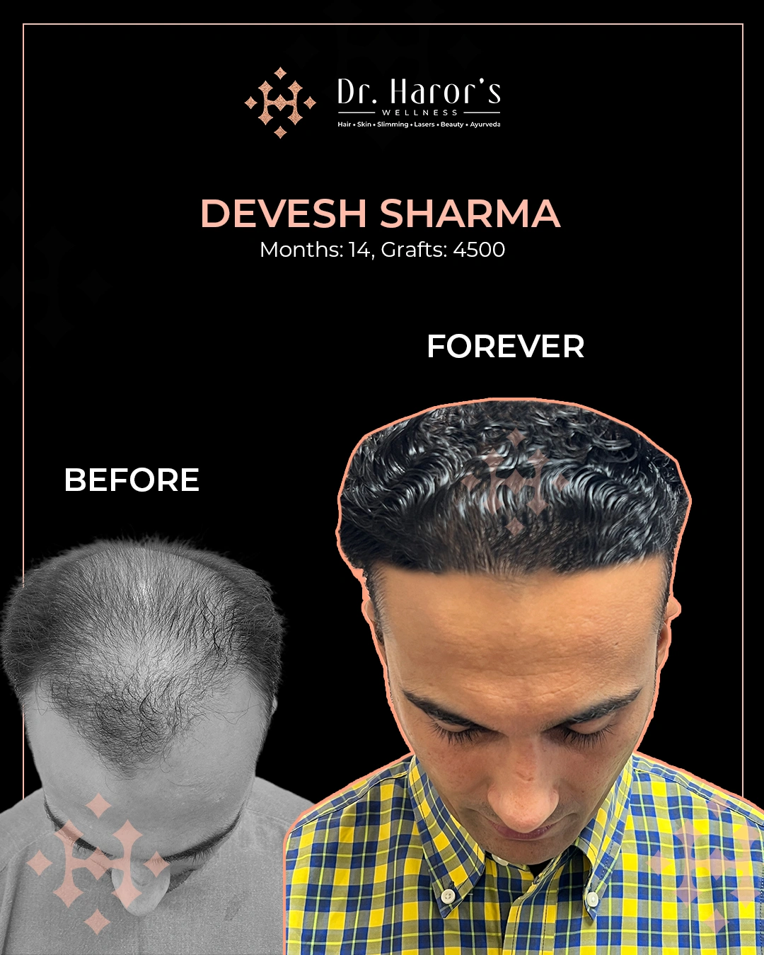 Hair Transplant Results in Delhi NCR India