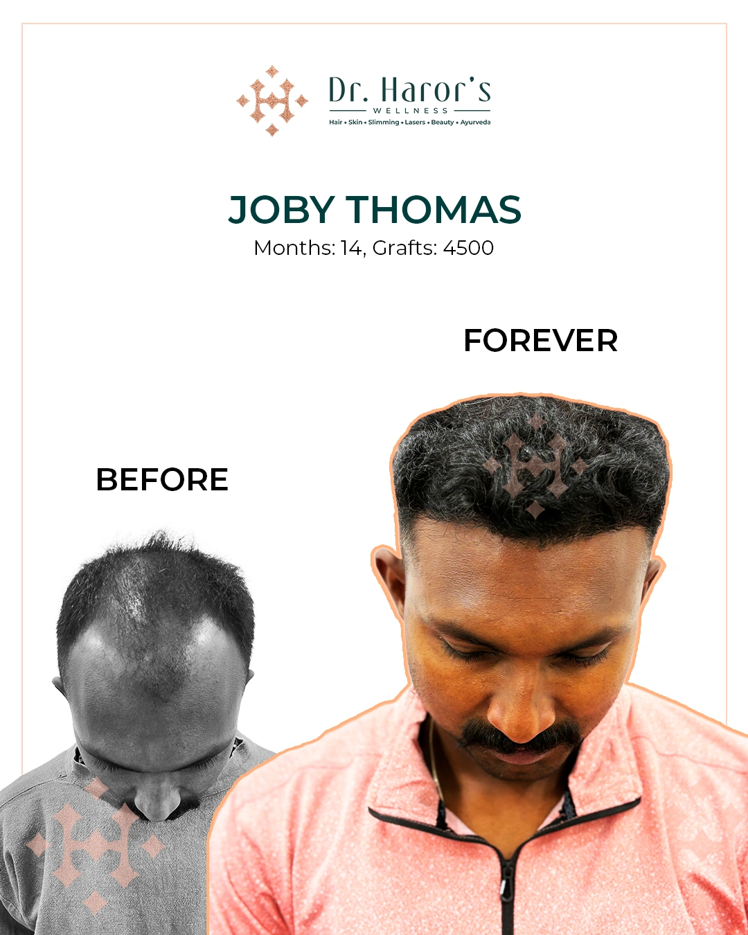 Hair Transplant Results in Delhi NCR India