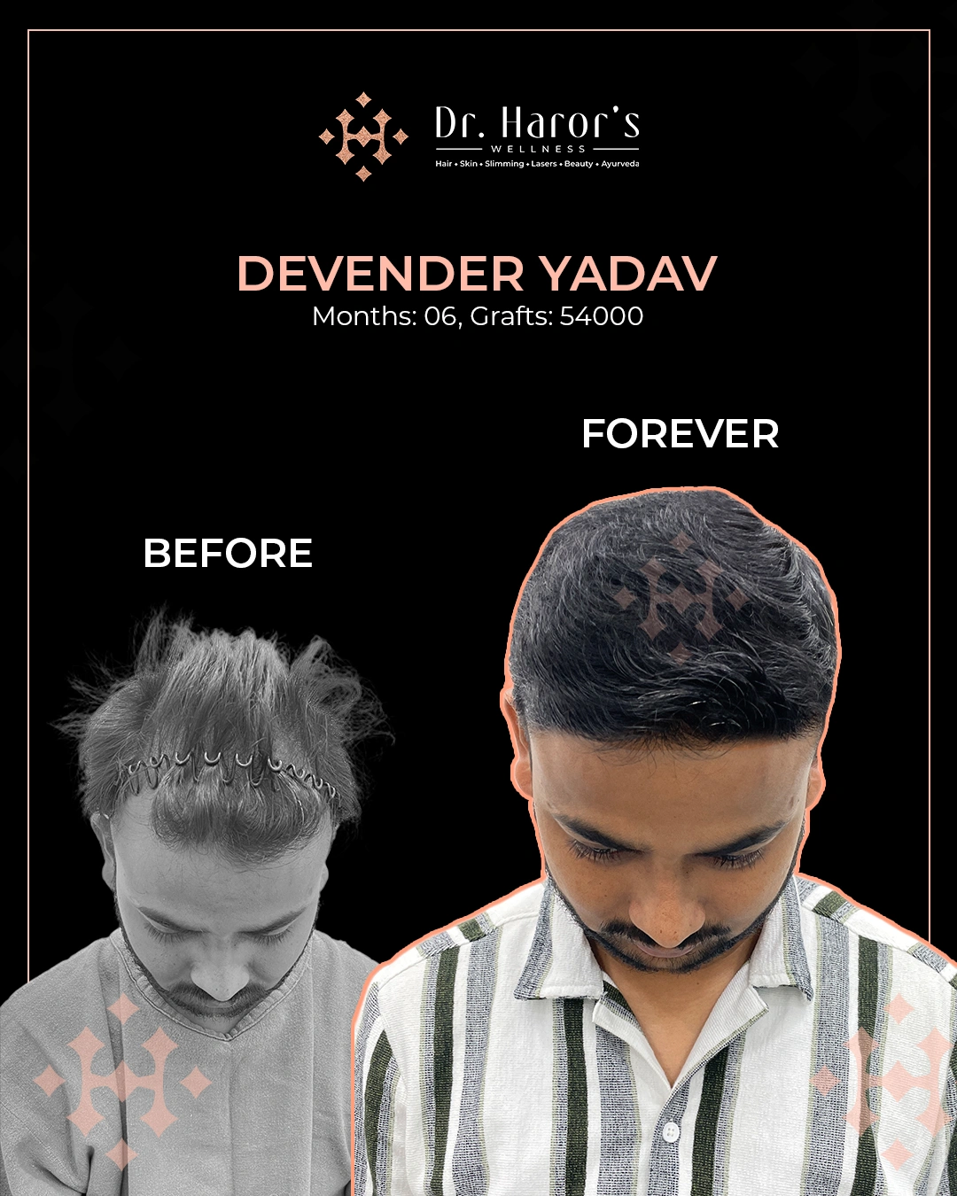 Hair Transplant Results in Delhi NCR India