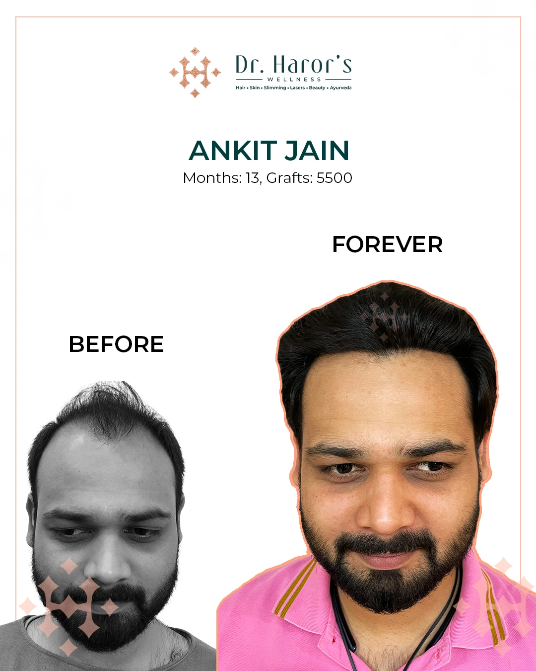 Hair Transplant Results in Delhi NCR India
