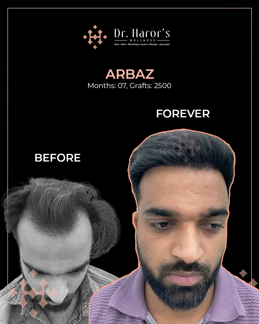 Hair Transplant Results in Delhi NCR India