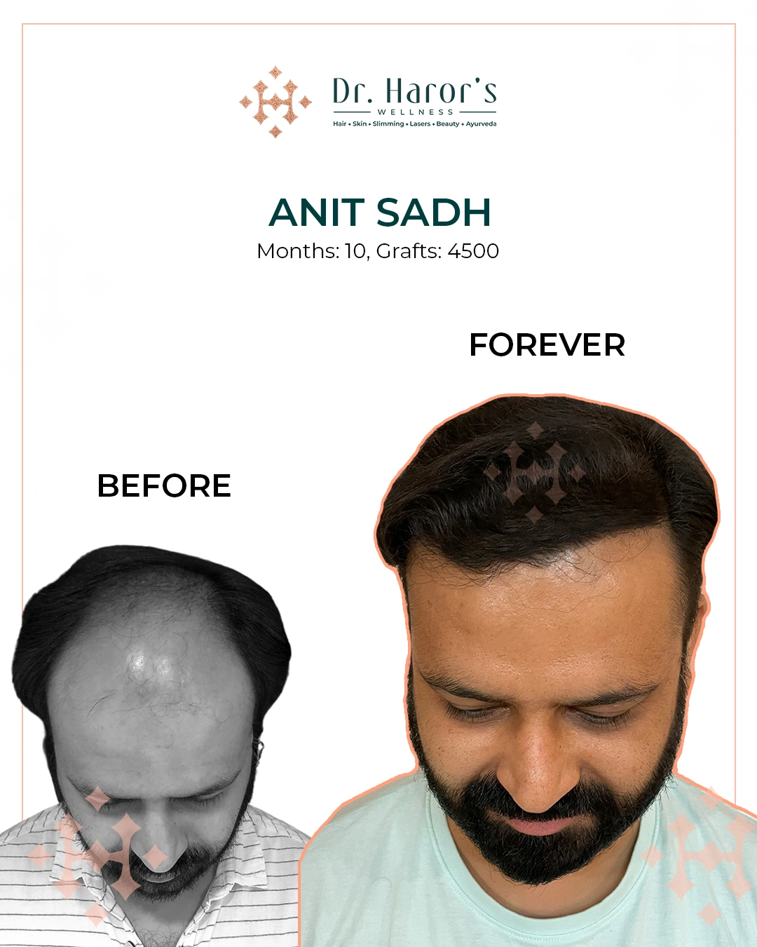 Hair Transplant Results in Delhi NCR India