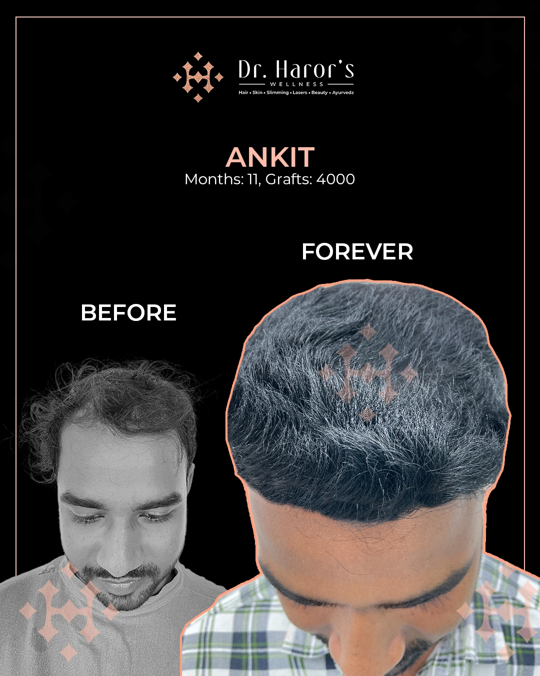 Hair Transplant Results in Delhi NCR India