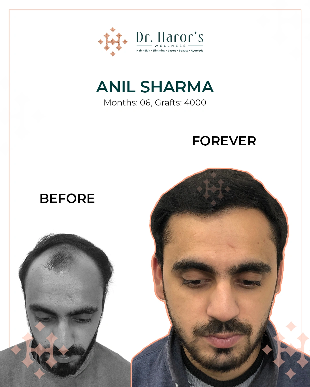 Hair Transplant Results in Delhi NCR India