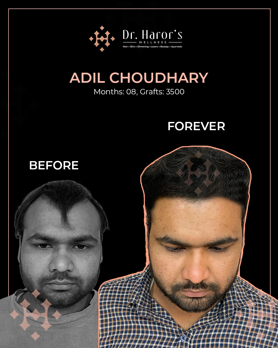 Hair Transplant Results in Delhi NCR India