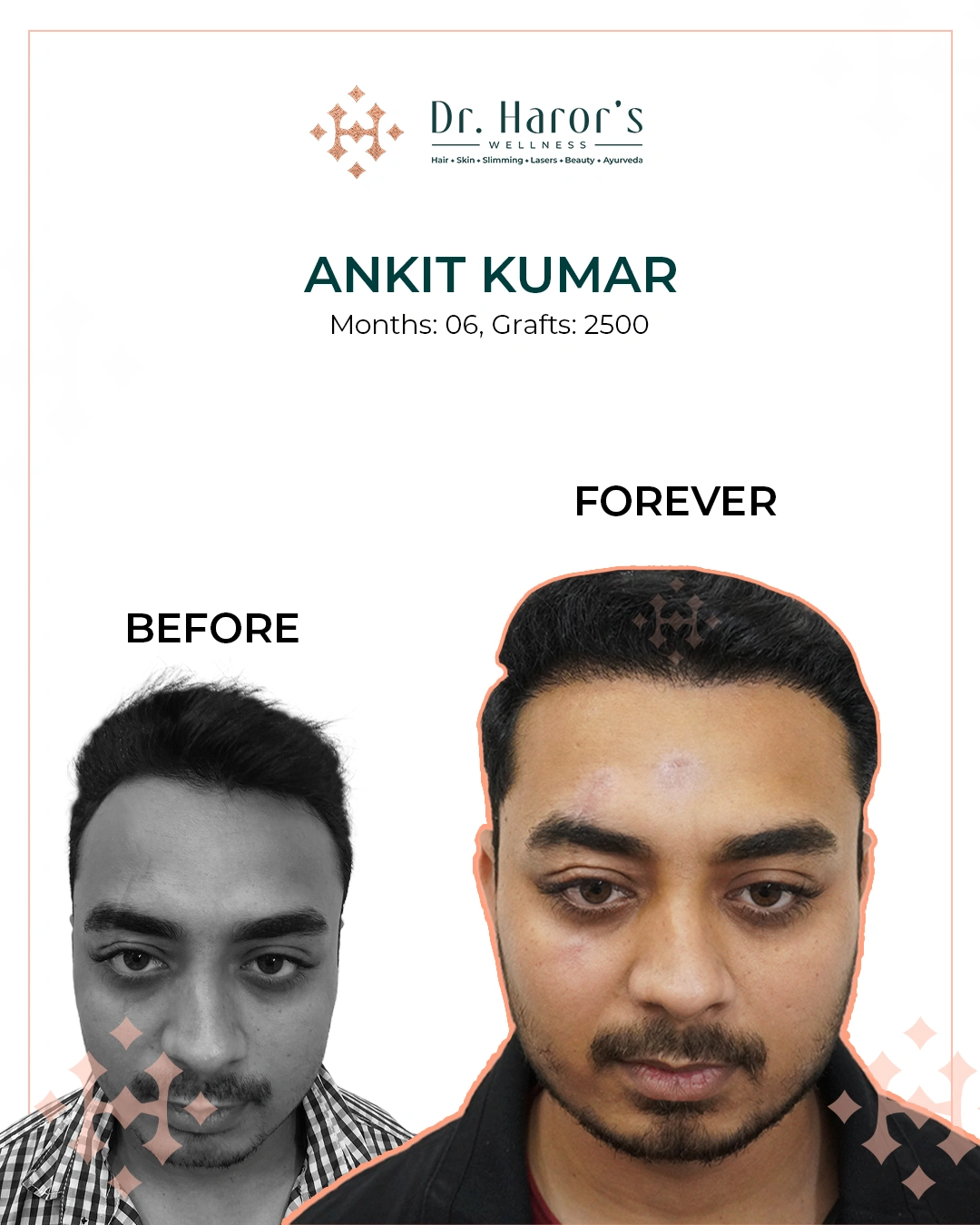 Hair Transplant Results in Delhi NCR India