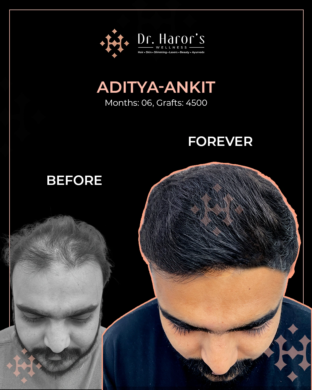 Hair Transplant Results in Delhi NCR India