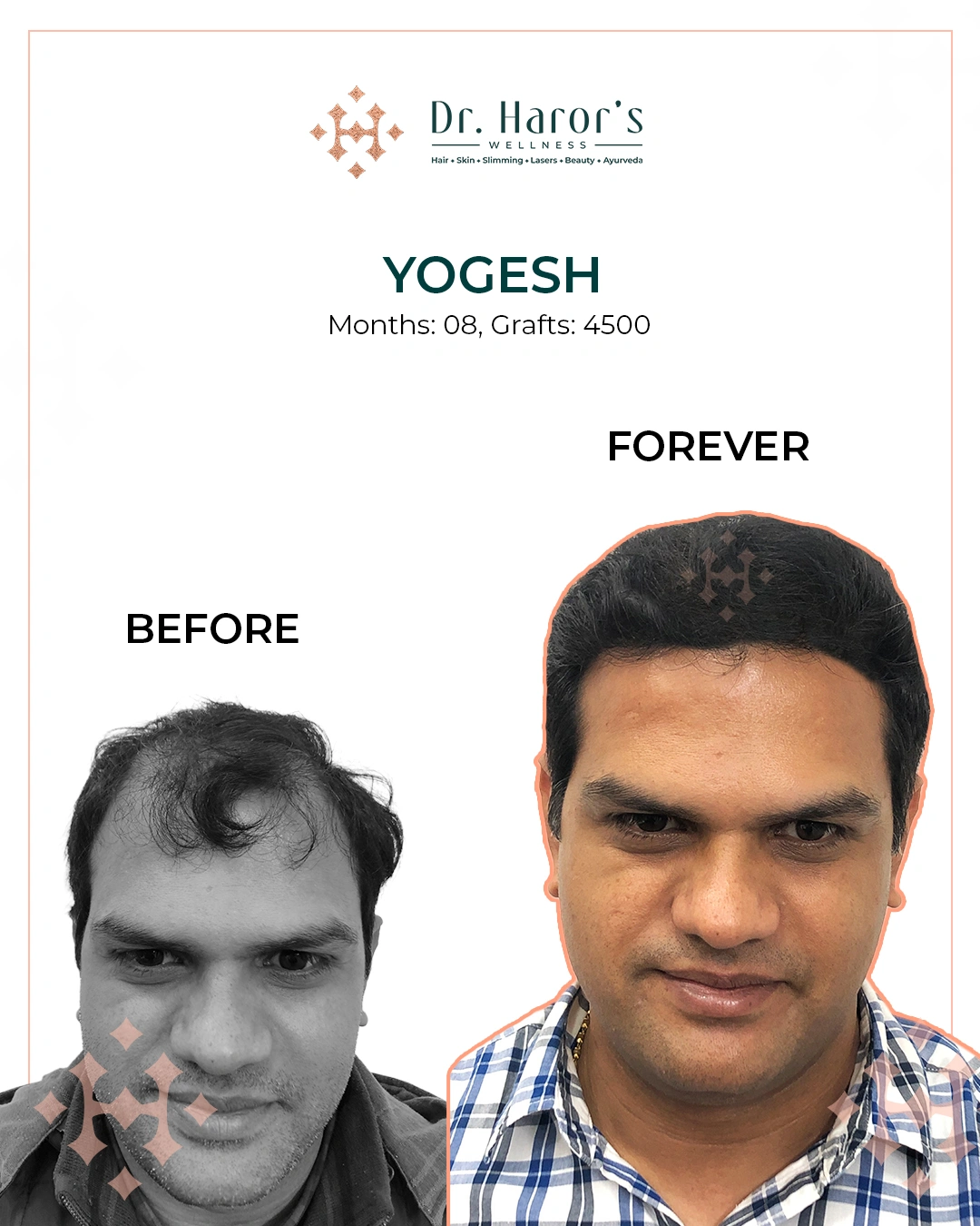 Hair Transplant Results in Delhi NCR India