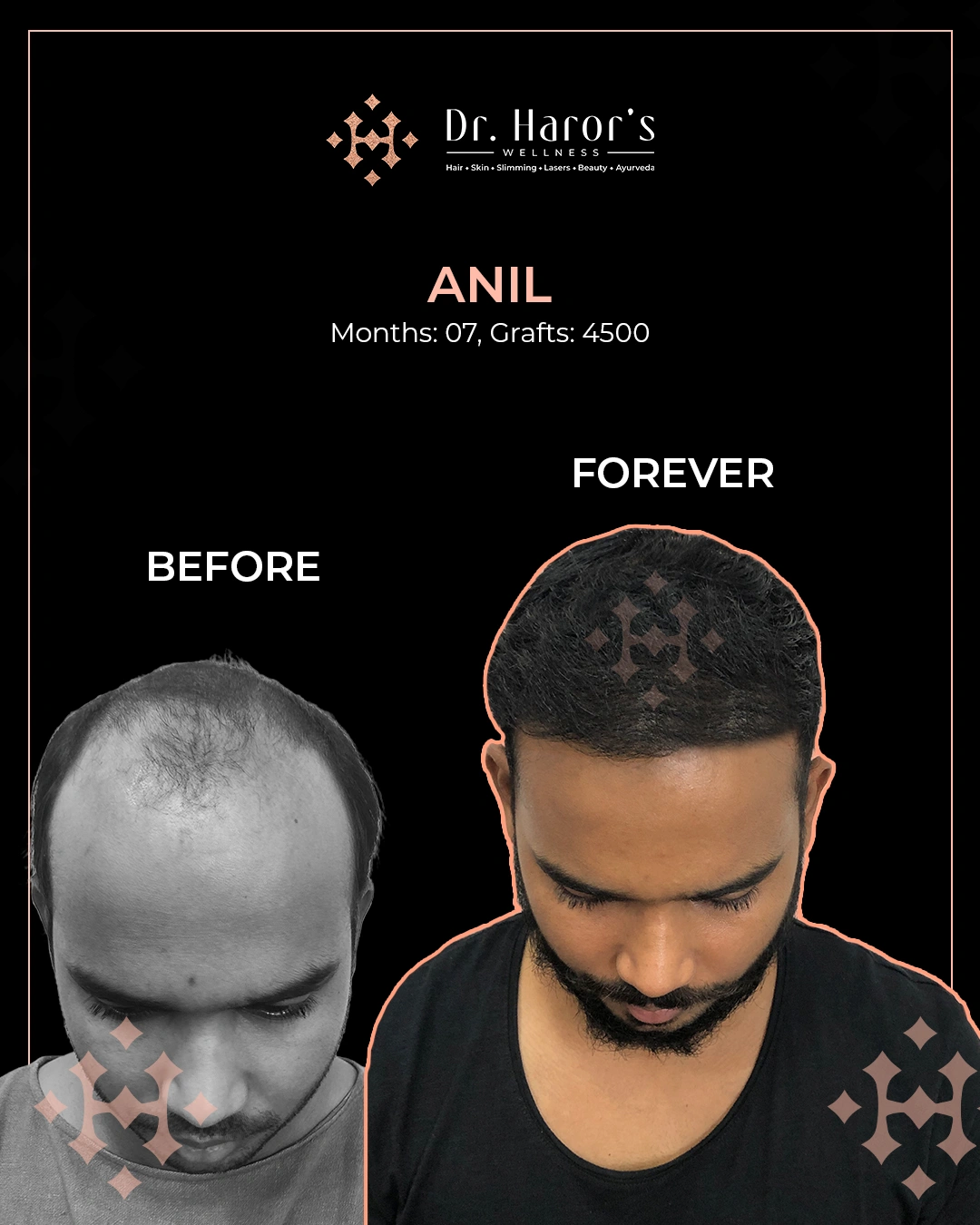 Hair Transplant Results in Delhi NCR India