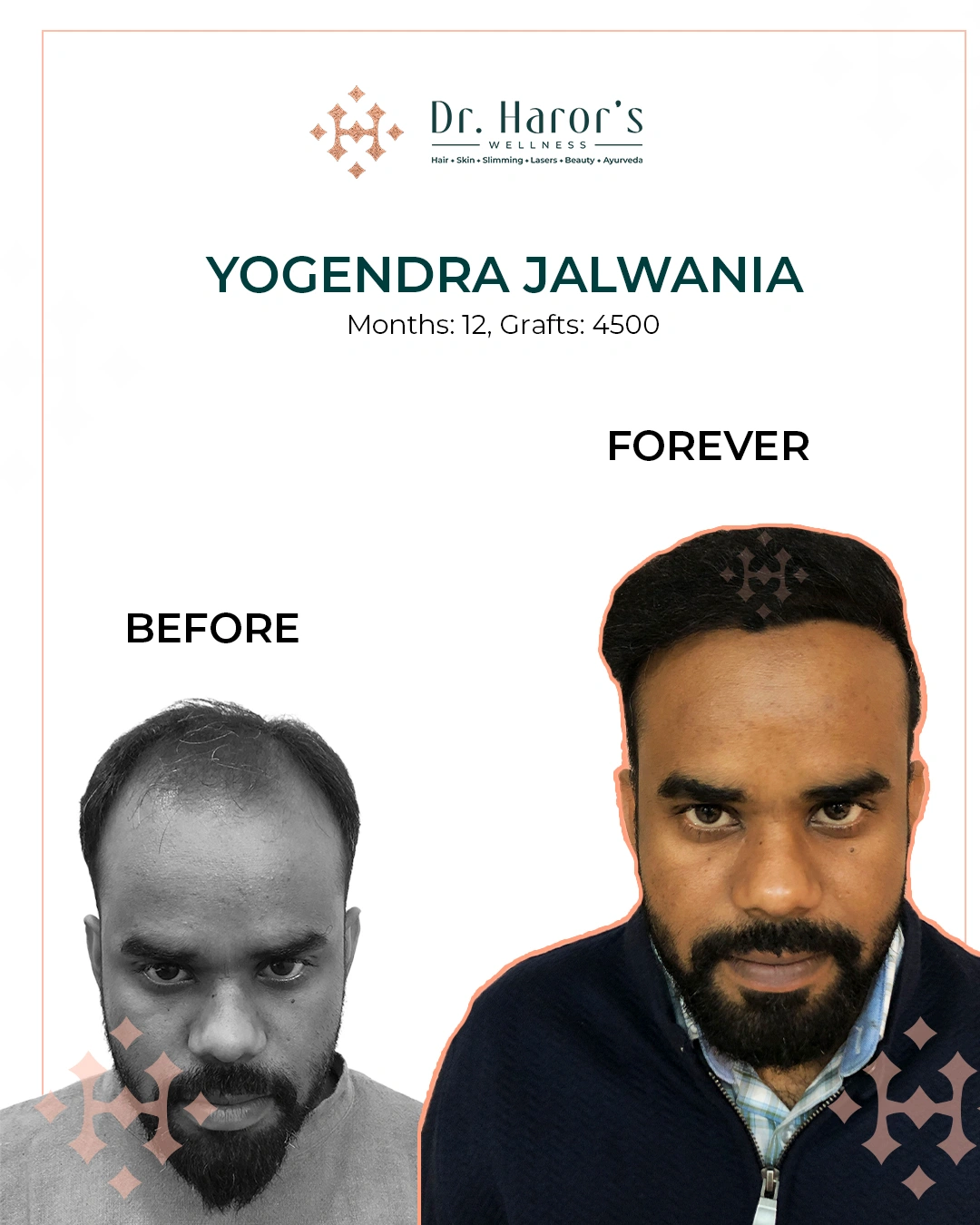 Hair Transplant Results in Delhi NCR India