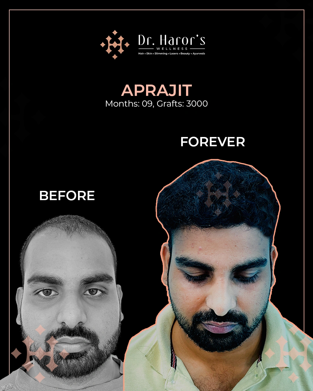 Hair Transplant Results in Delhi NCR India