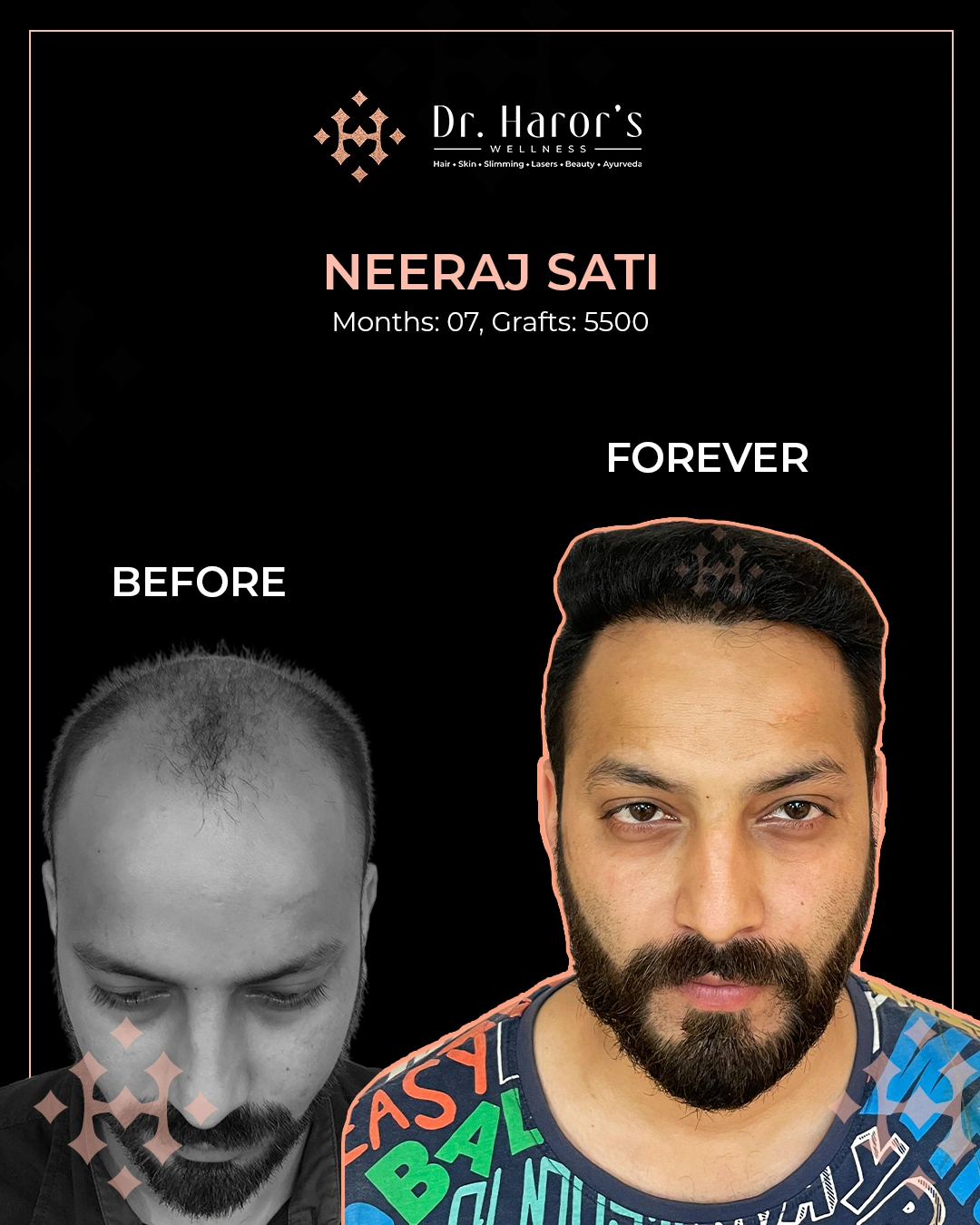 Hair Transplant Results in Delhi NCR India