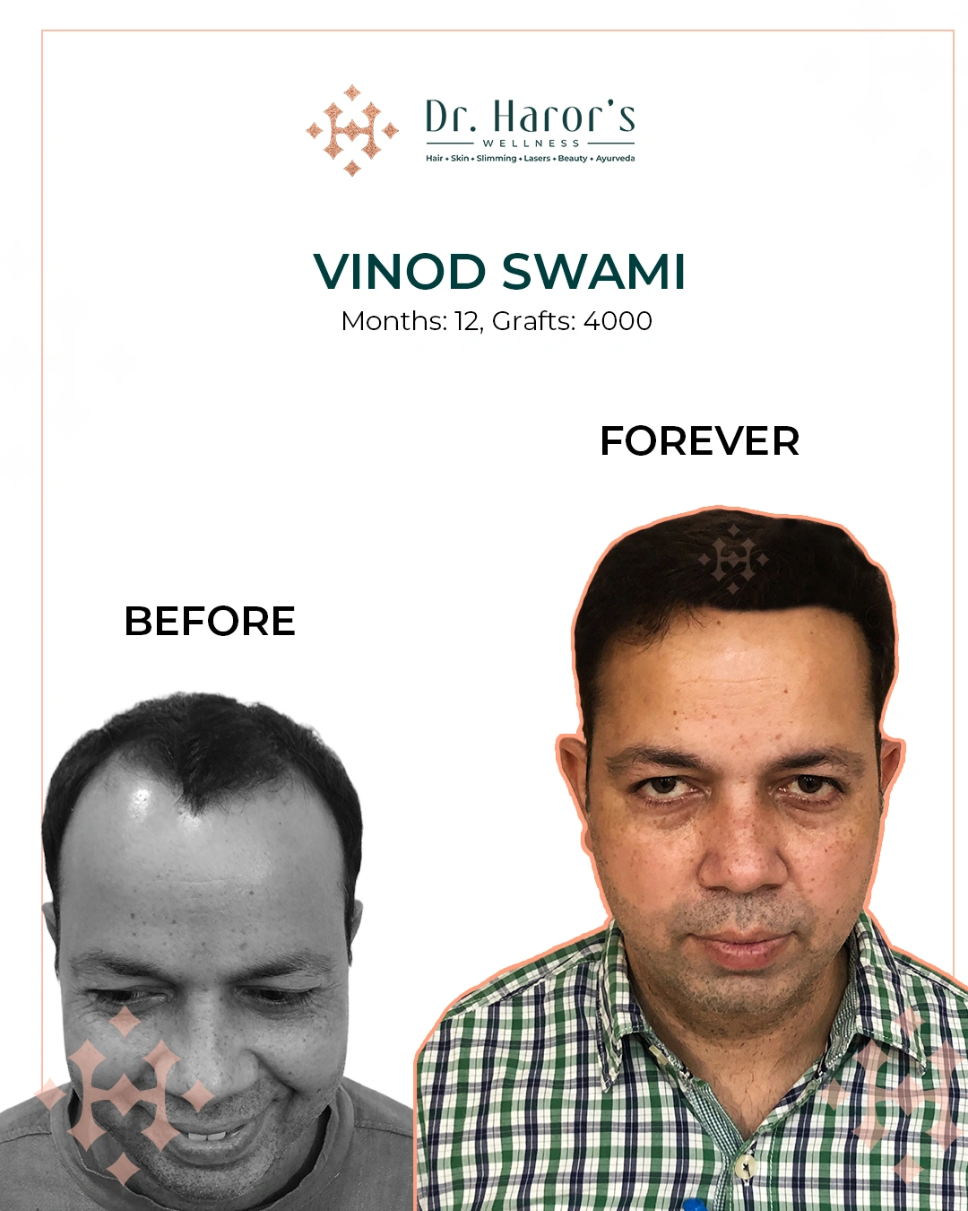 Hair Transplant Results in Delhi NCR India