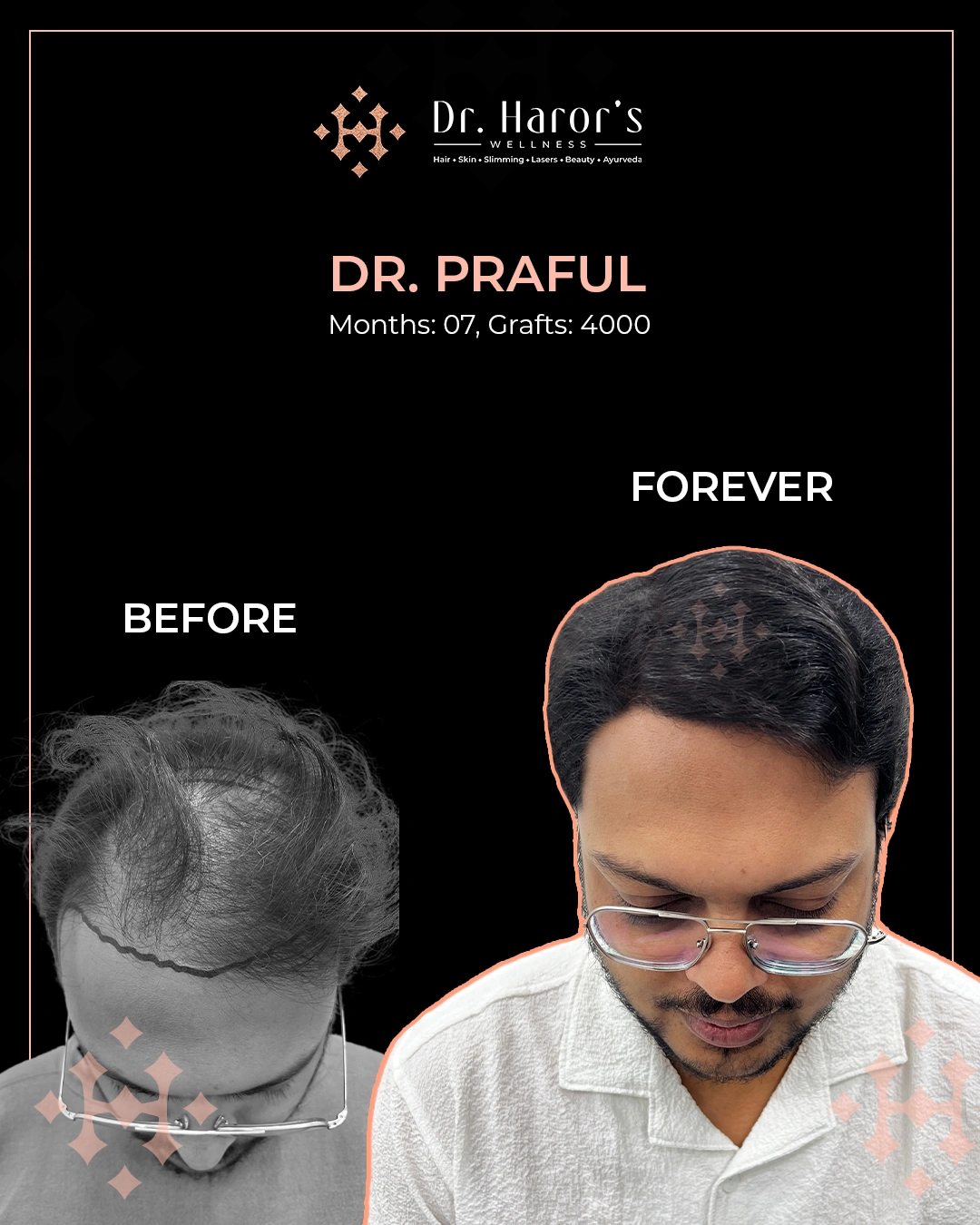 Hair Transplant Results in Delhi NCR India