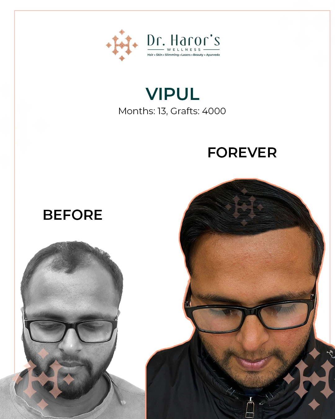 Hair Transplant Results in Delhi NCR India