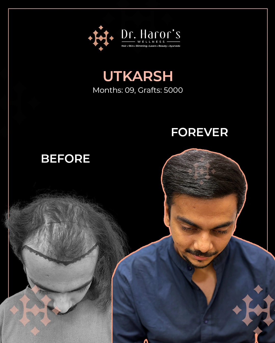Hair Transplant Results in Delhi NCR India