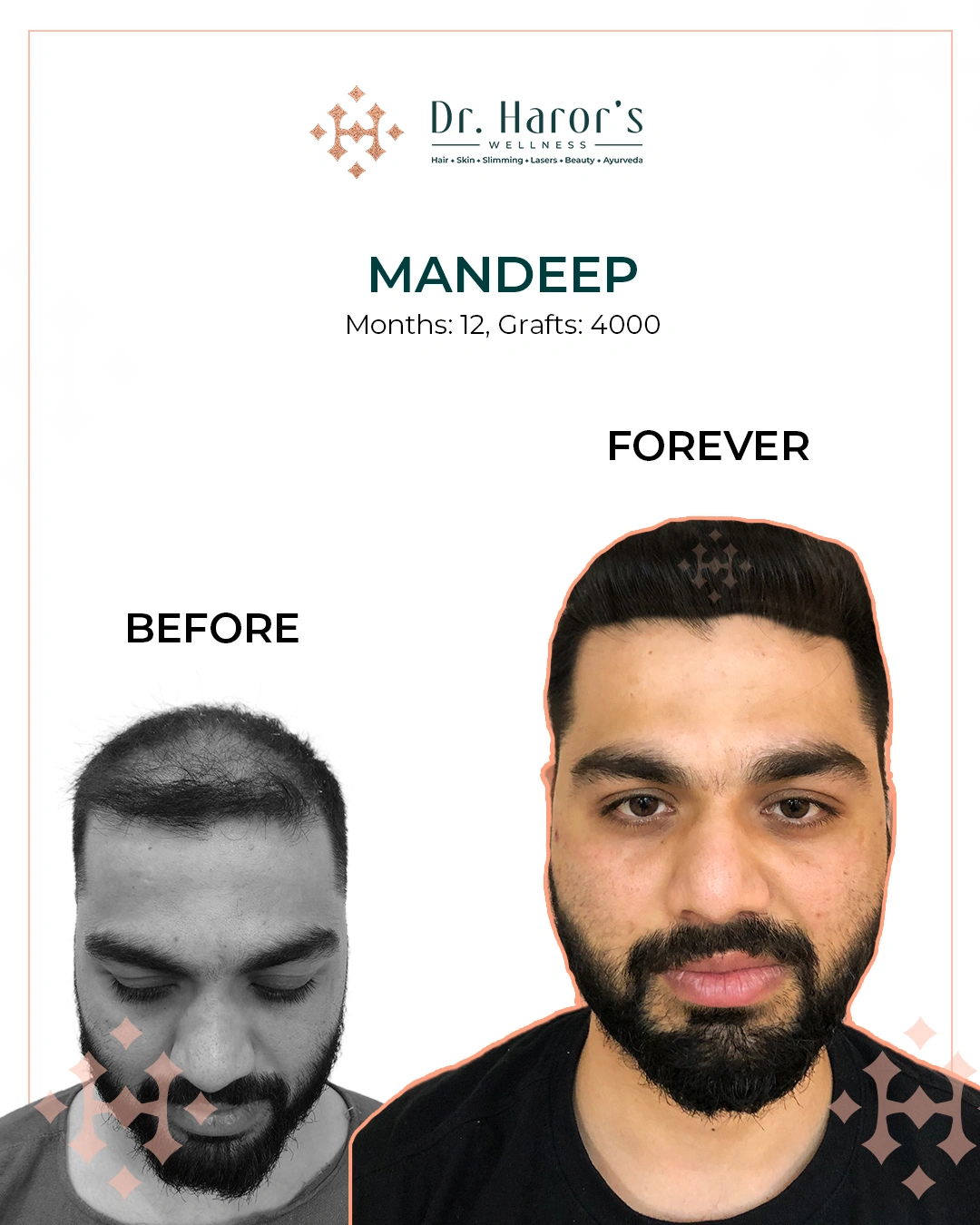 Hair Transplant Results in Delhi NCR India