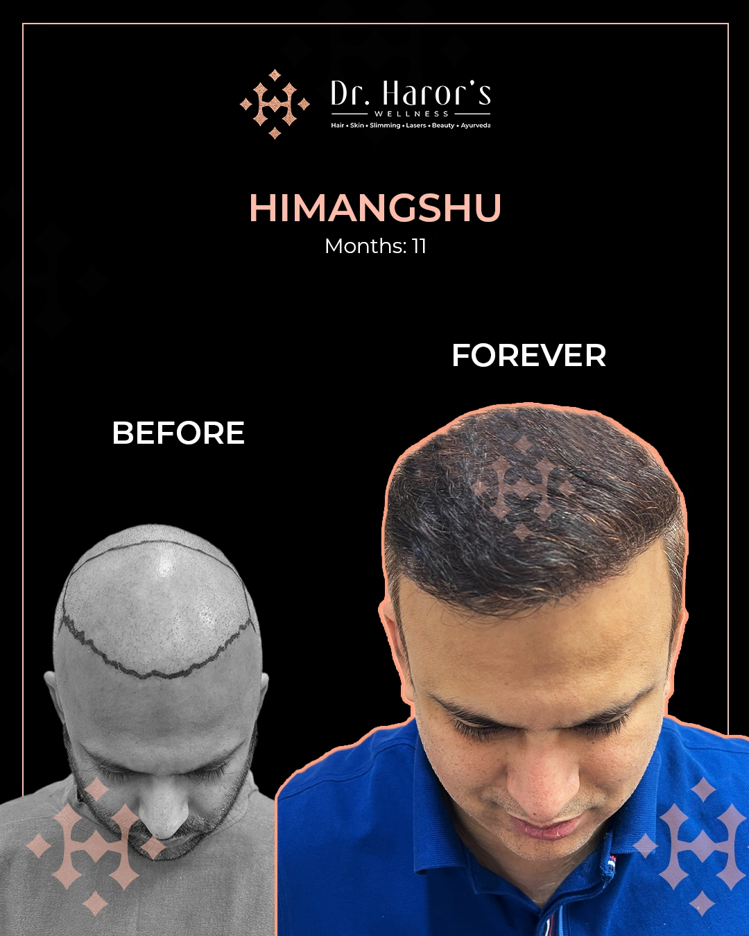 Hair Transplant Results in Delhi NCR India