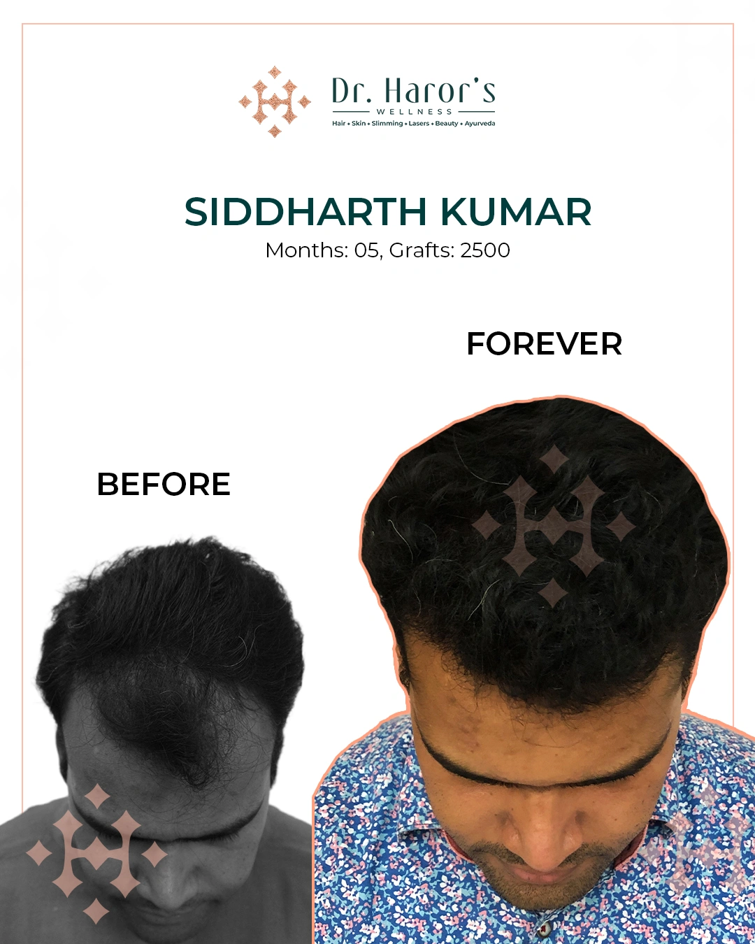 Hair Transplant Results in Delhi NCR India
