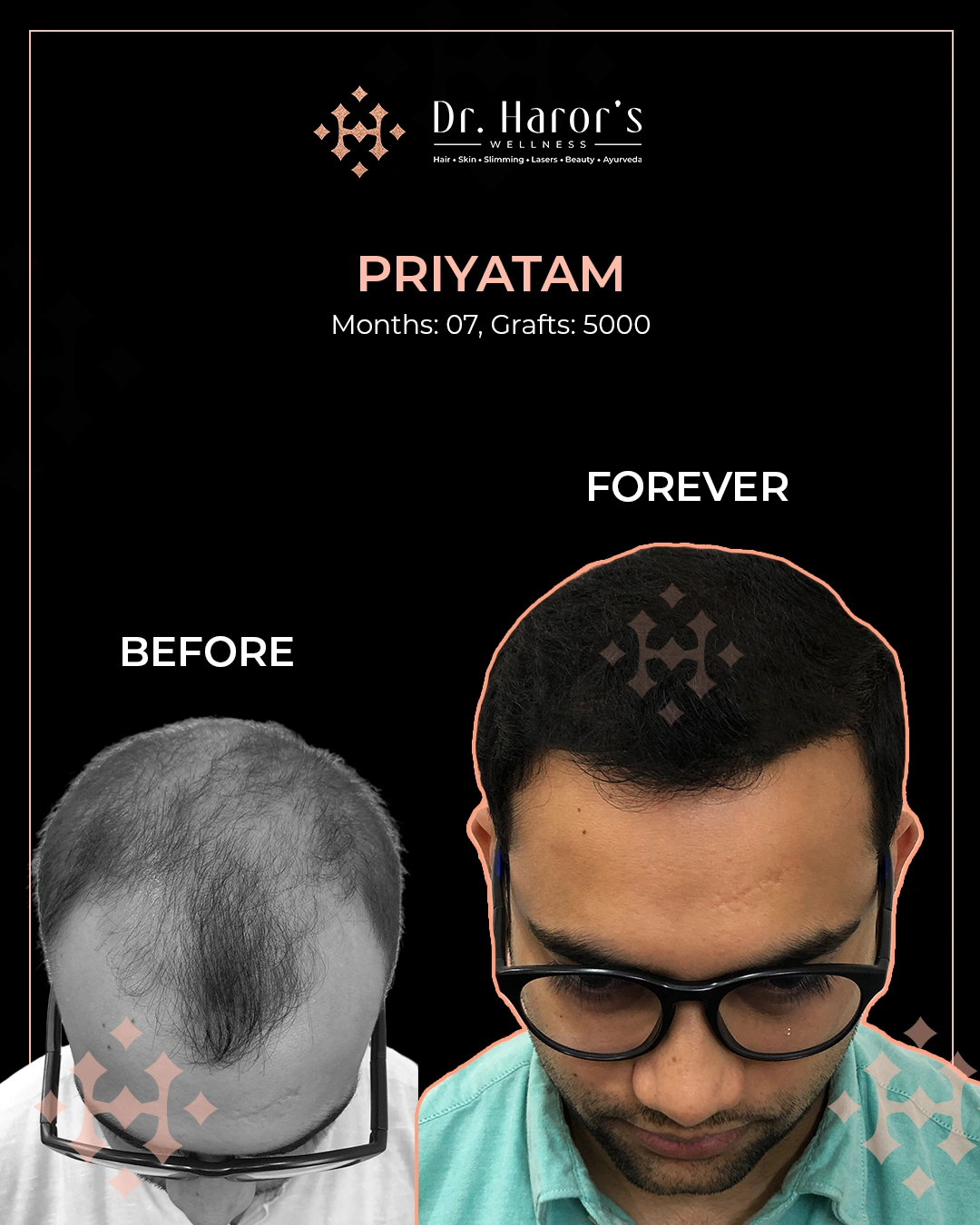 Hair Transplant Results in Delhi NCR India