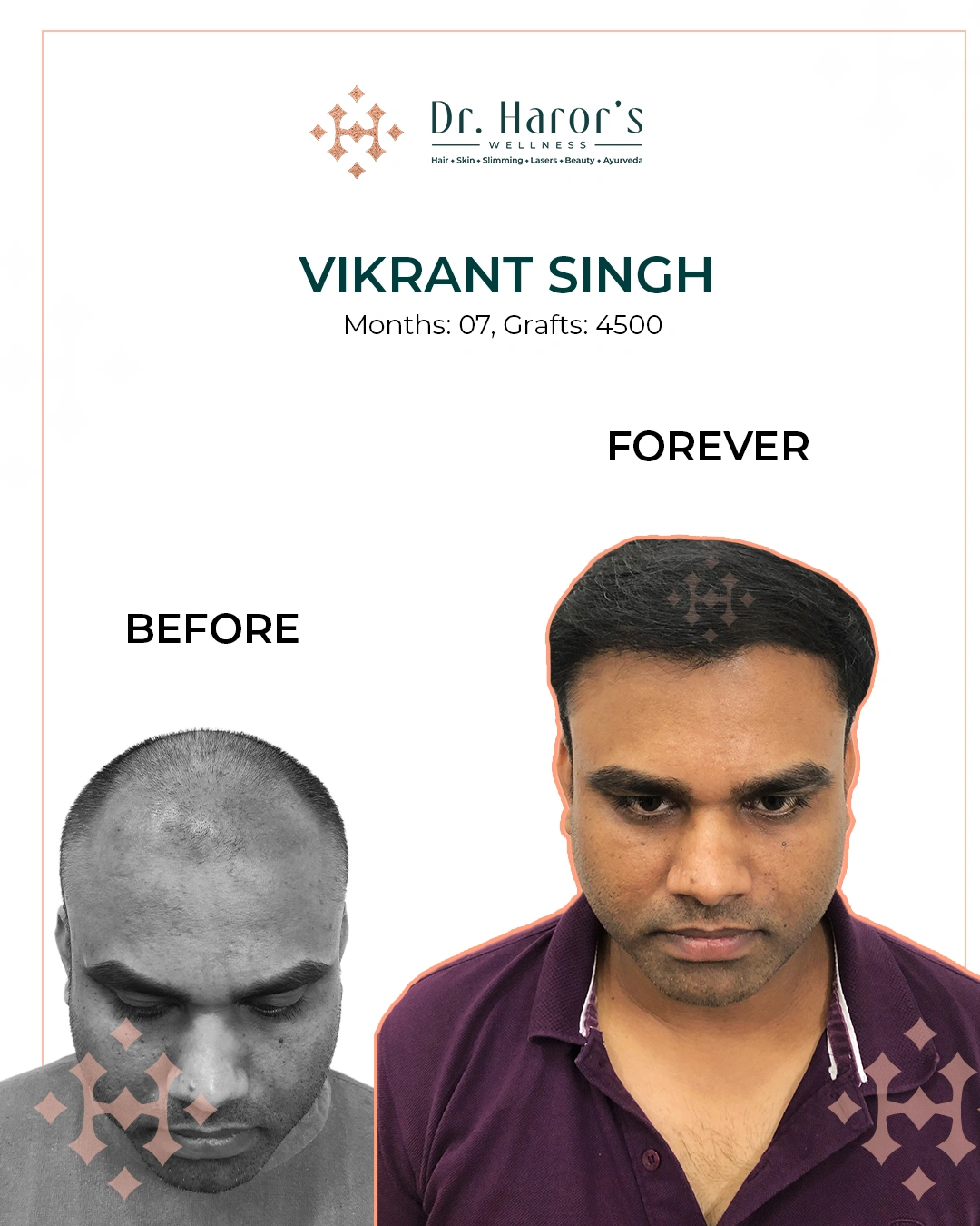 Hair Transplant Results in Delhi NCR India