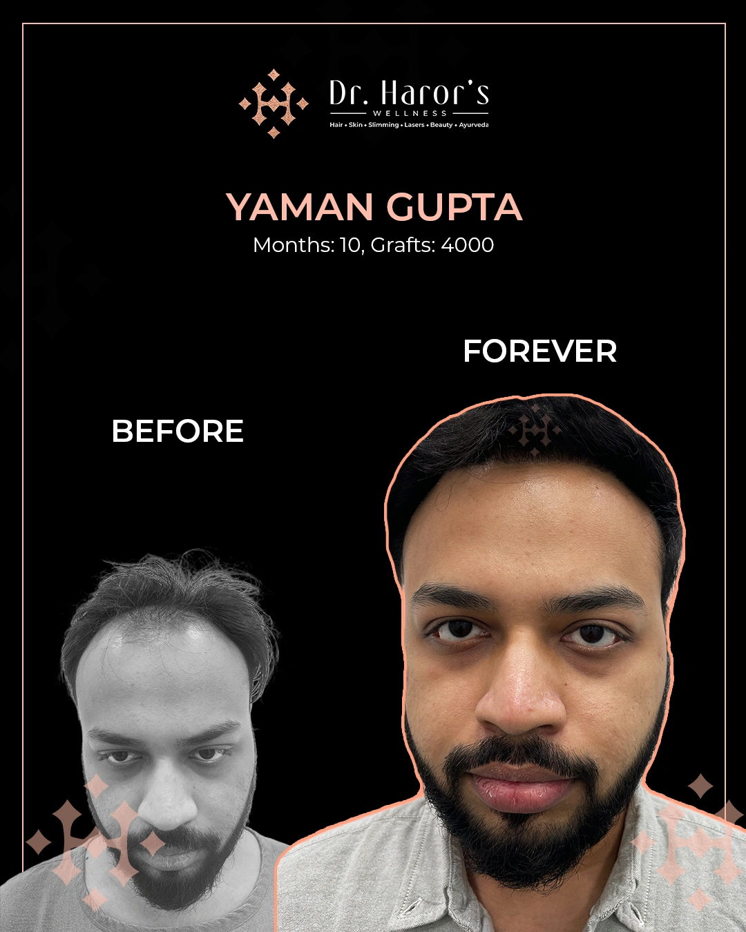 Hair Transplant Results in Delhi NCR India