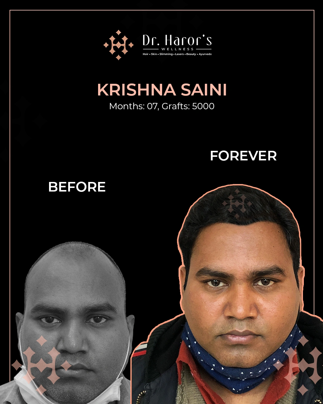 Hair Transplant Results in Delhi NCR India