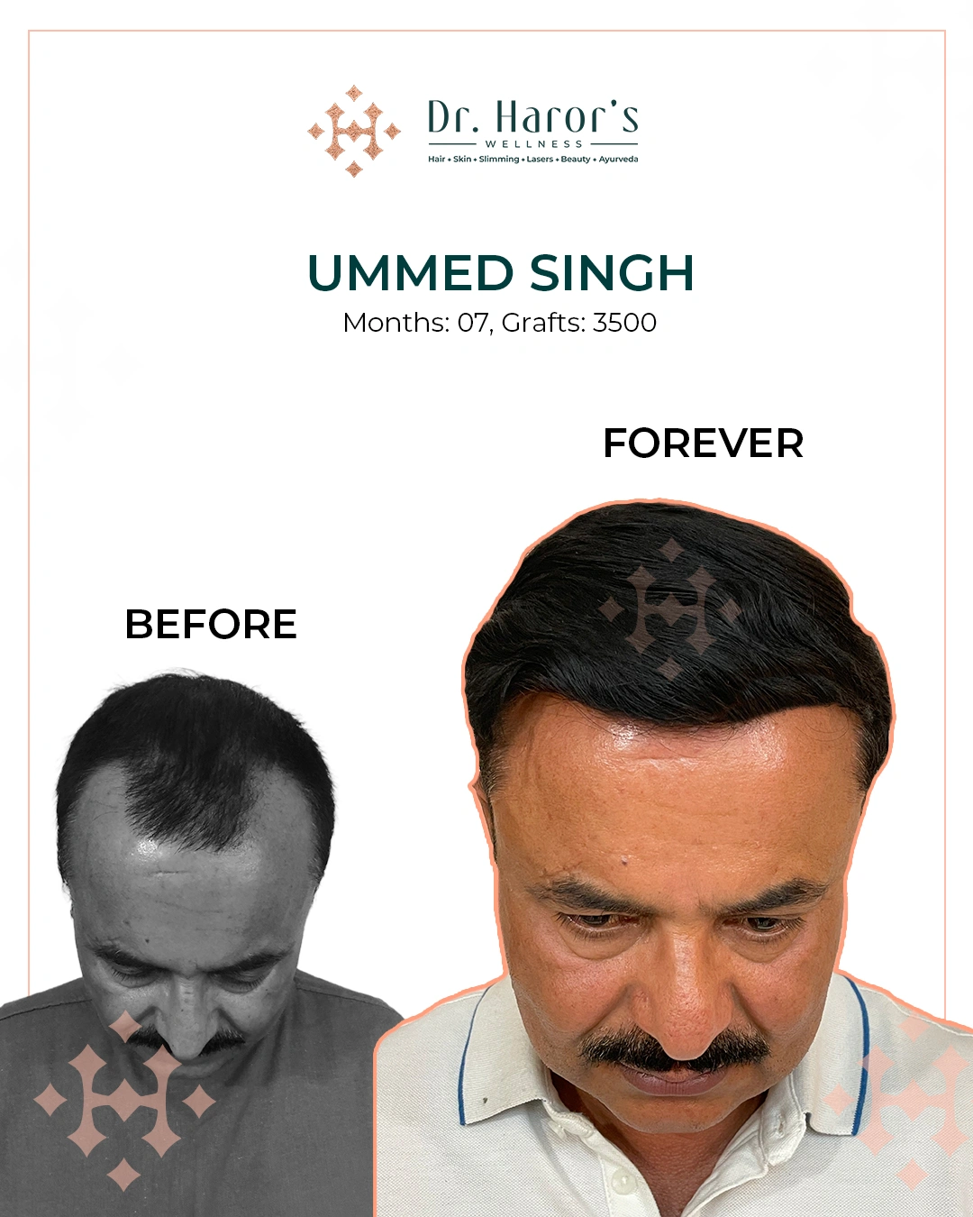 Hair Transplant Results in Delhi NCR India