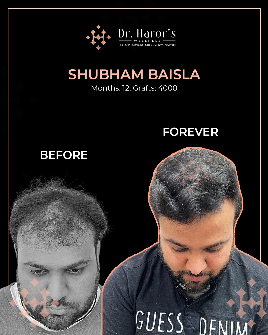 Hair Transplant Results in Delhi NCR India