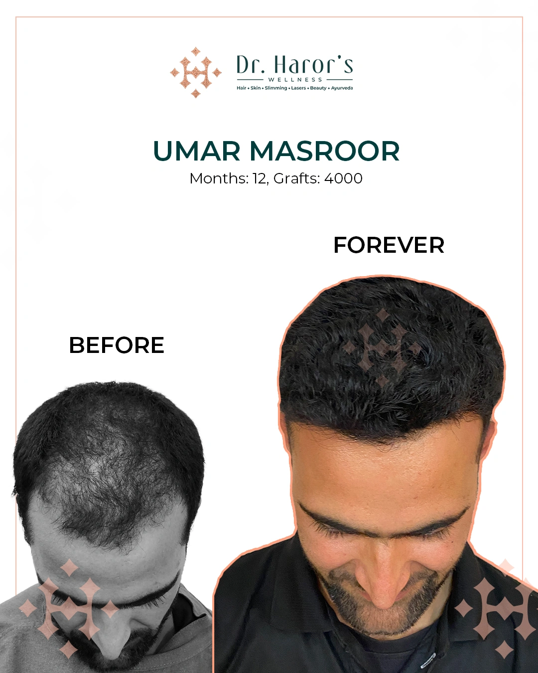 Hair Transplant Results in Delhi NCR India