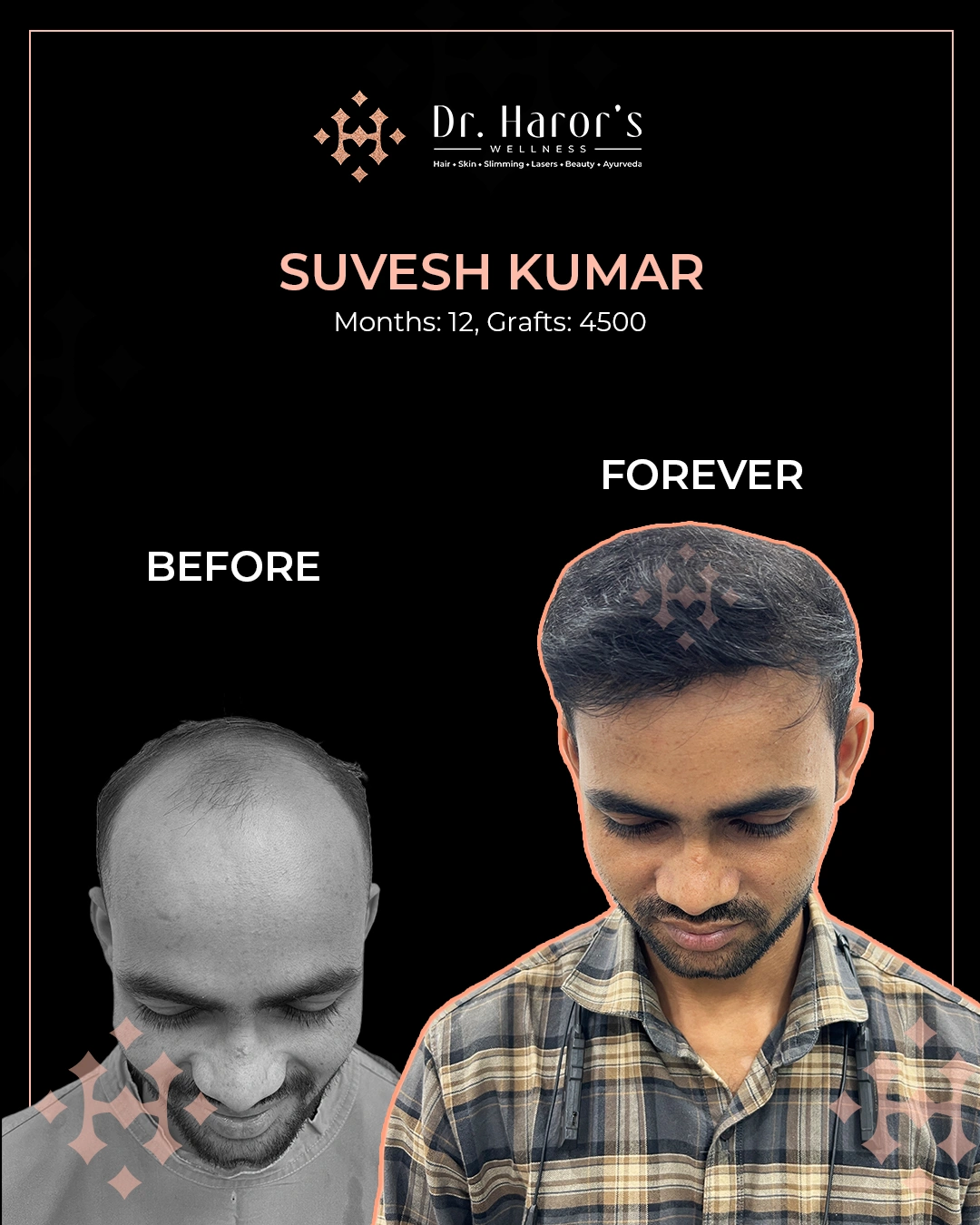 Hair Transplant Results in Delhi NCR India