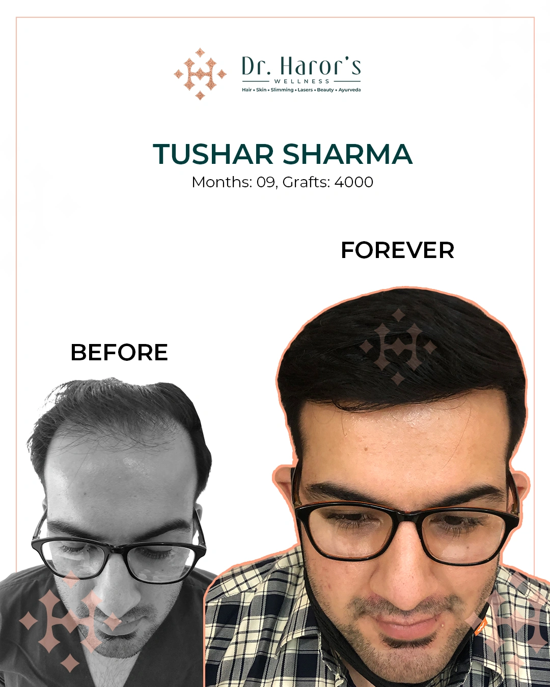 Hair Transplant Results in Delhi NCR India