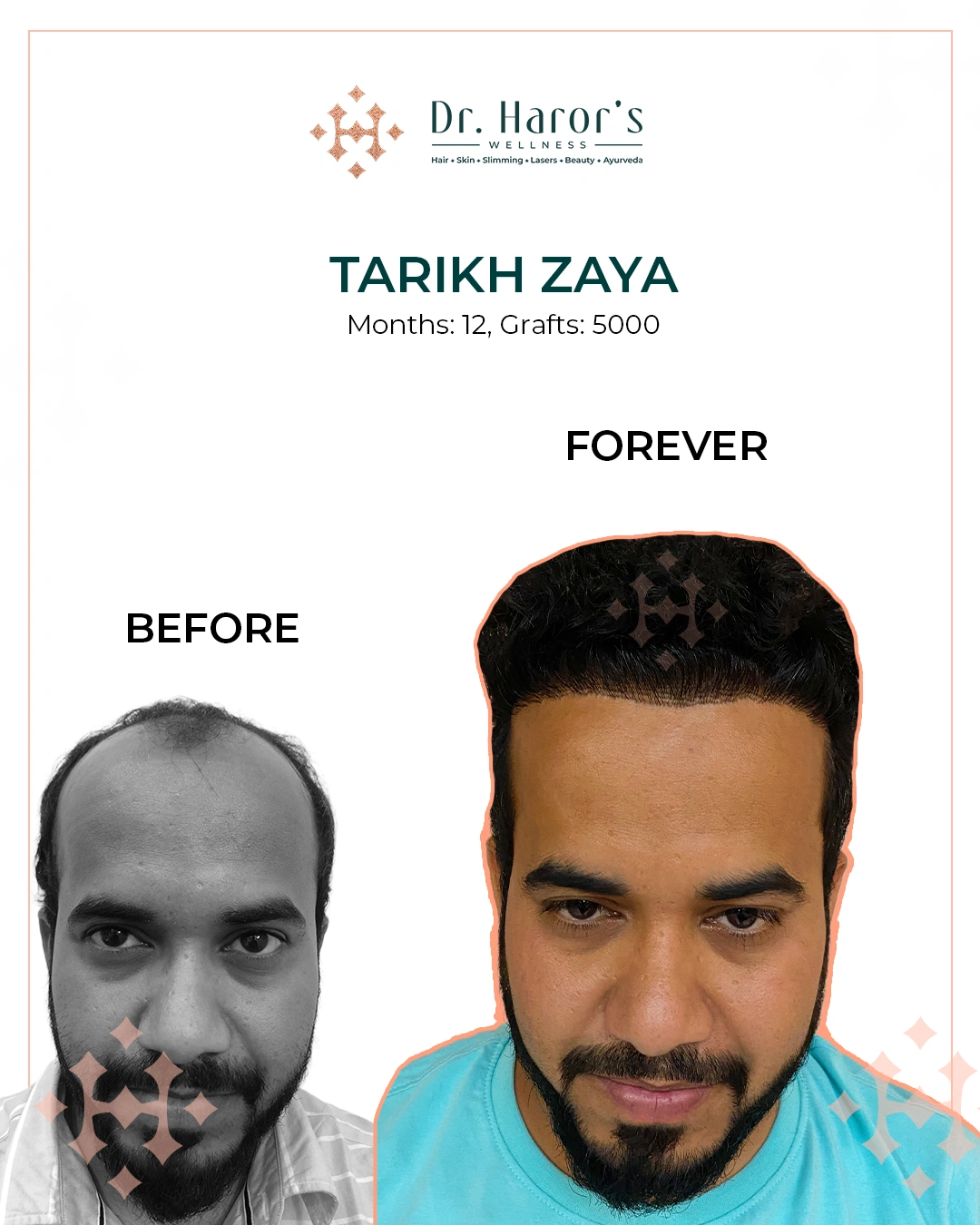 Hair Transplant Results in Delhi NCR India