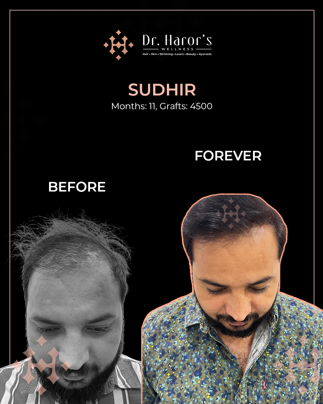 Hair Transplant Results in Delhi NCR India