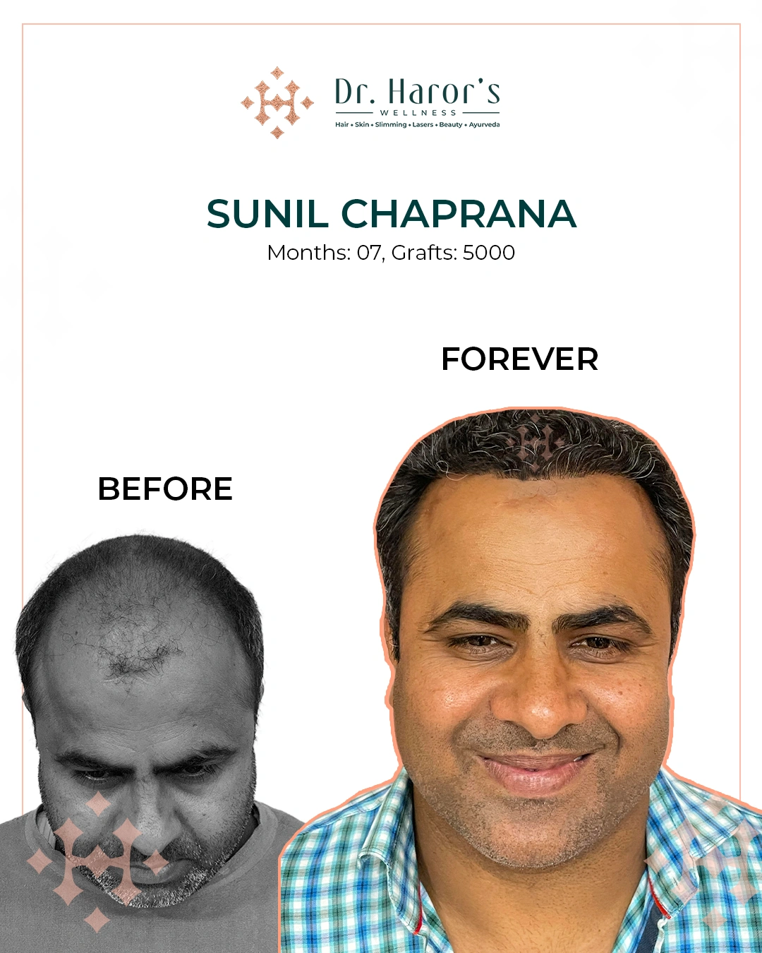 Hair Transplant Results in Delhi NCR India