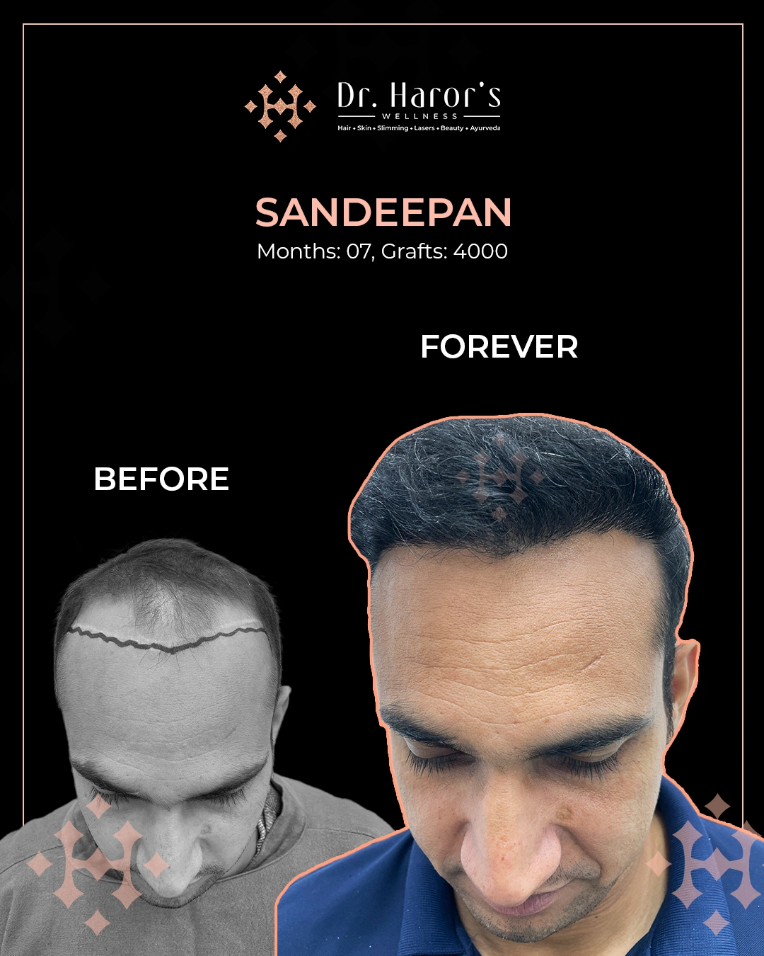 Hair Transplant Results in Delhi NCR India