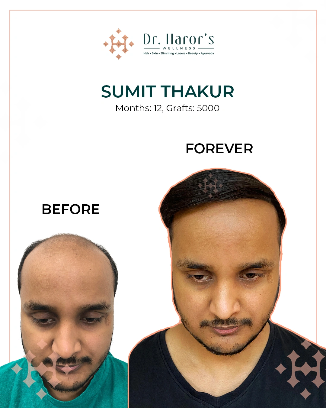Hair Transplant Results in Delhi NCR India