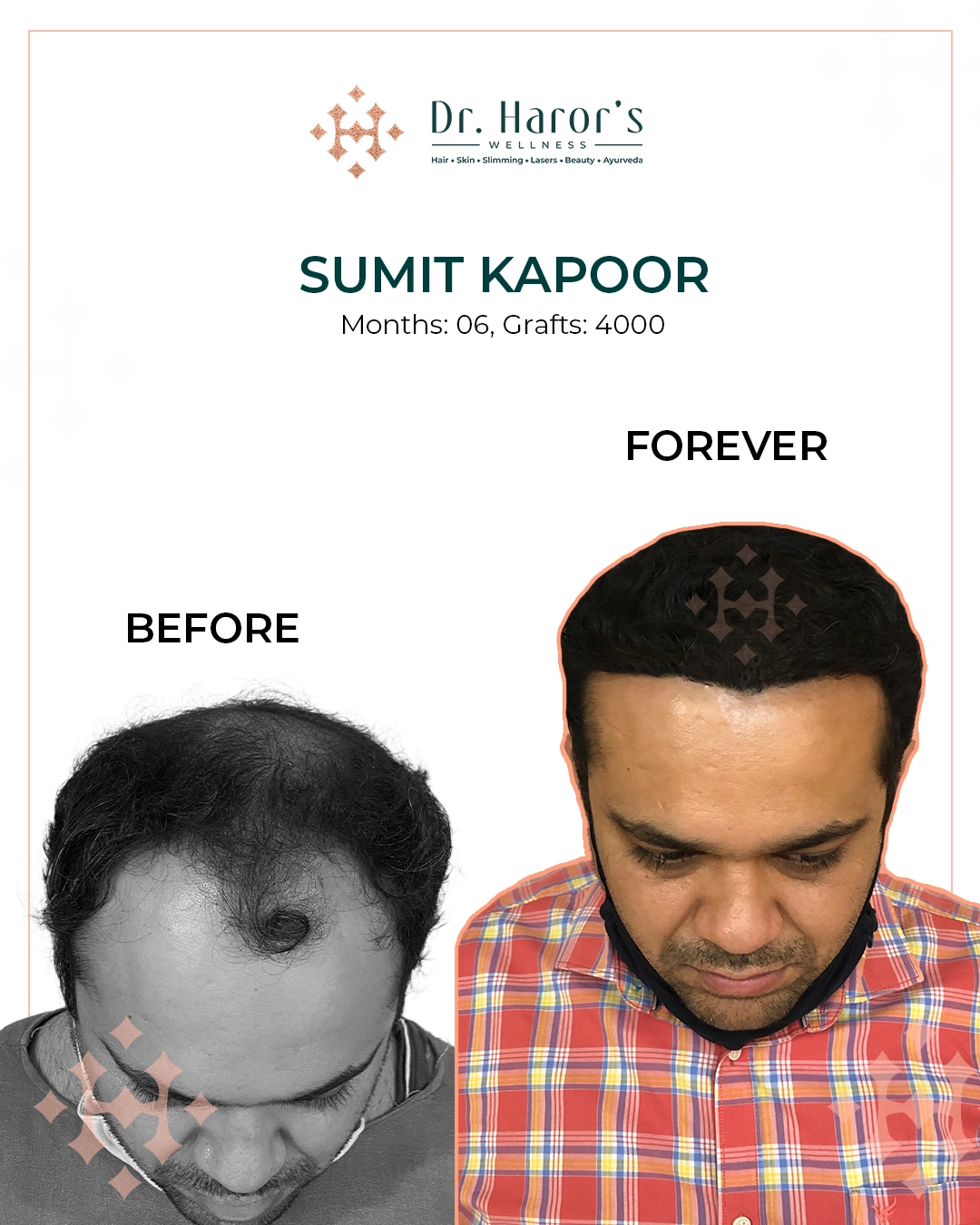 Hair Transplant Results in Delhi NCR India