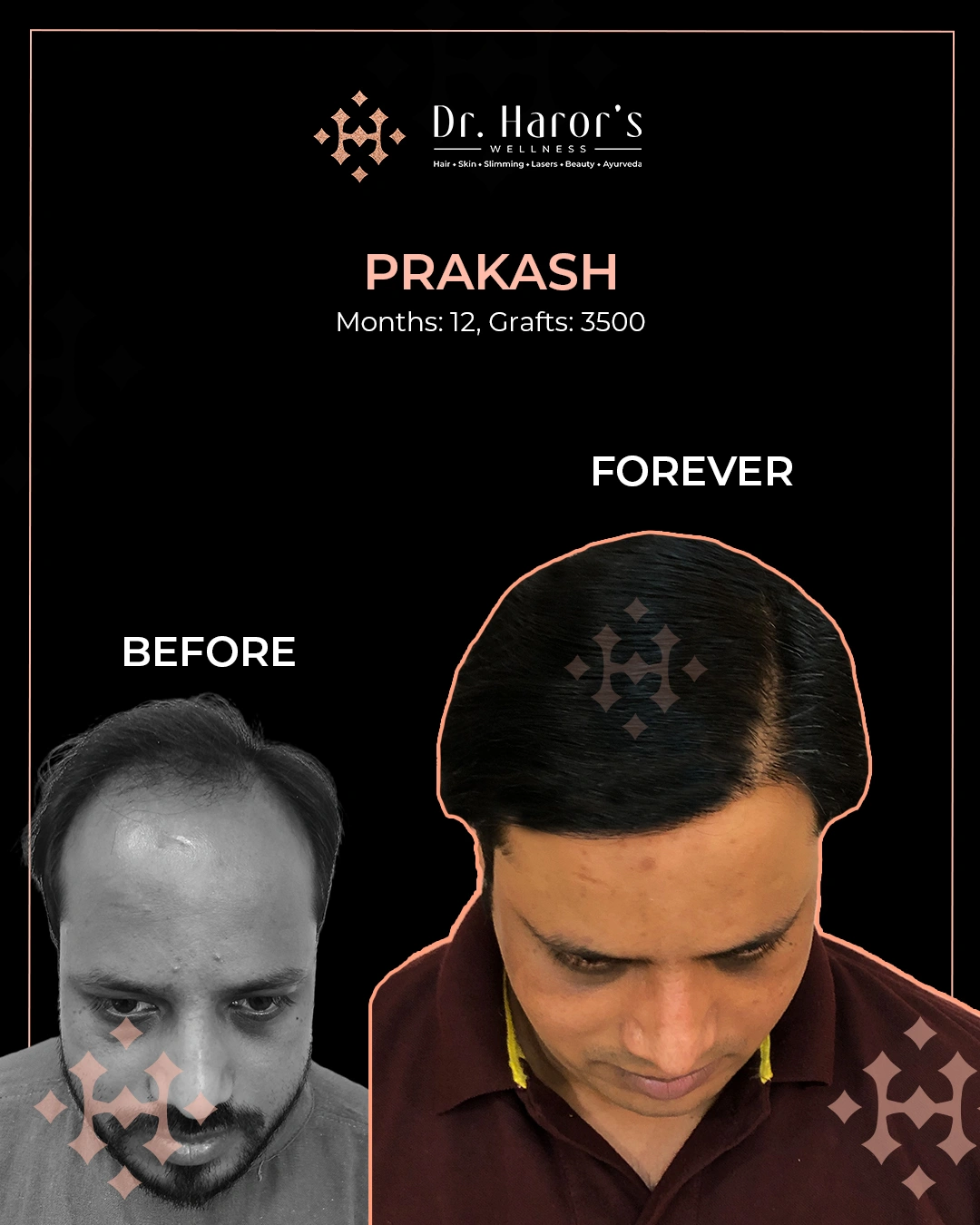 Hair Transplant Results in Delhi NCR India