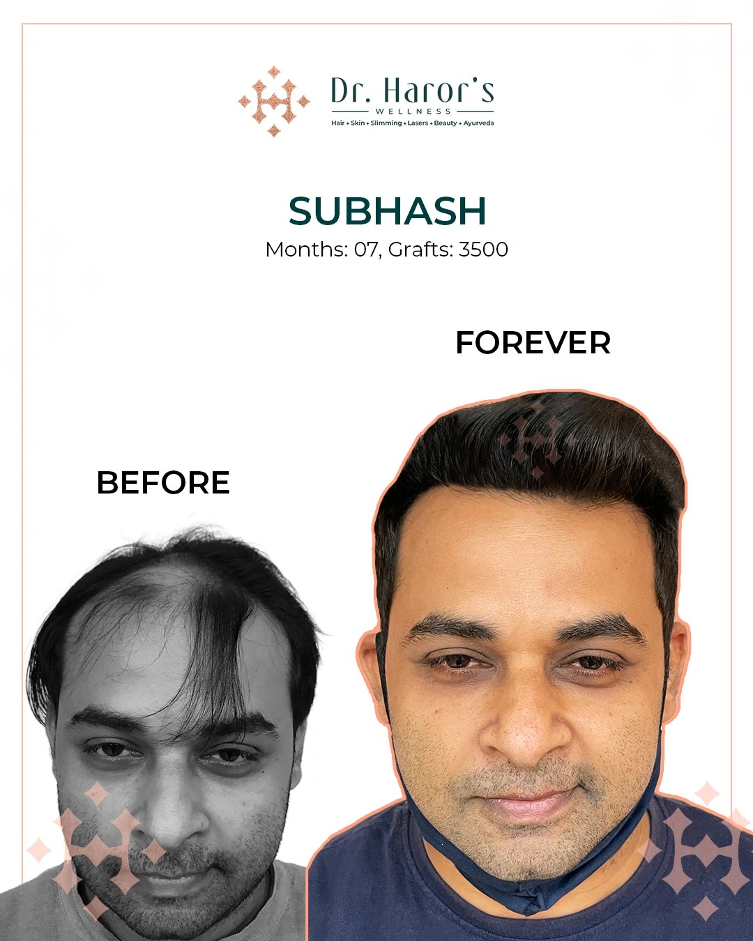 Hair Transplant Results in Delhi NCR India